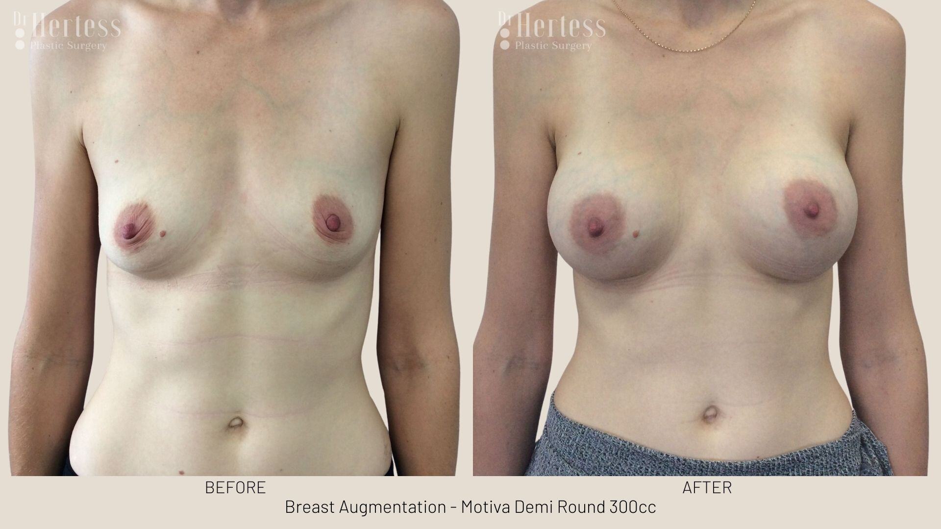 breast augmentation photos before and after