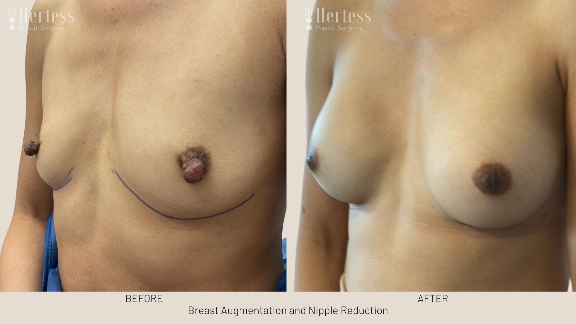 areolar reduction