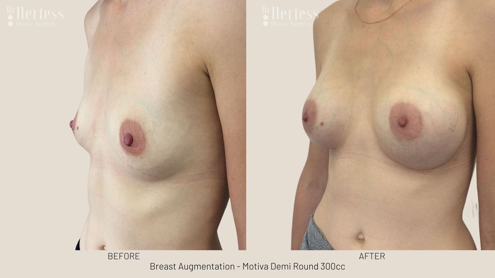 breast augmentation photos before and after