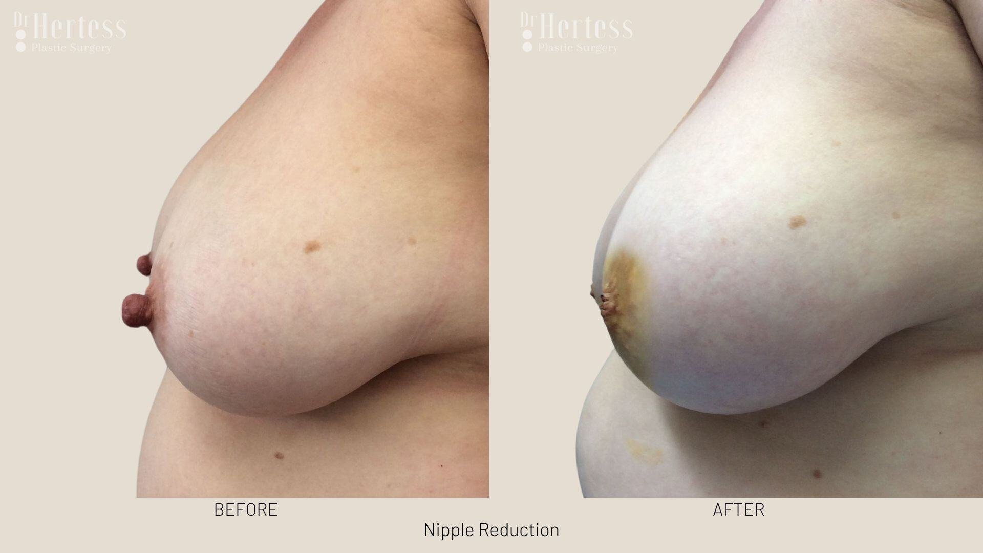 areolar reduction