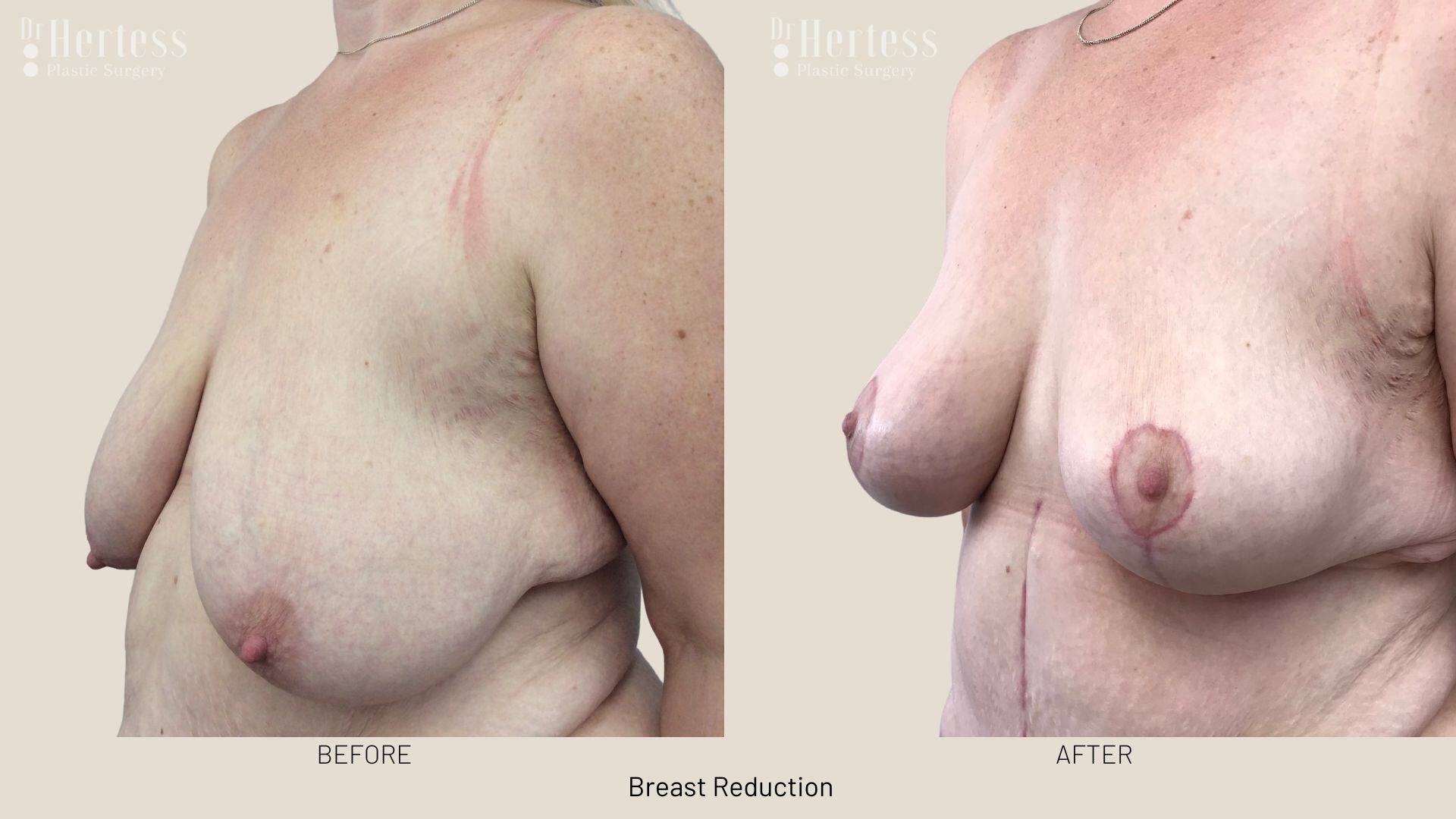 breast reduction before and after