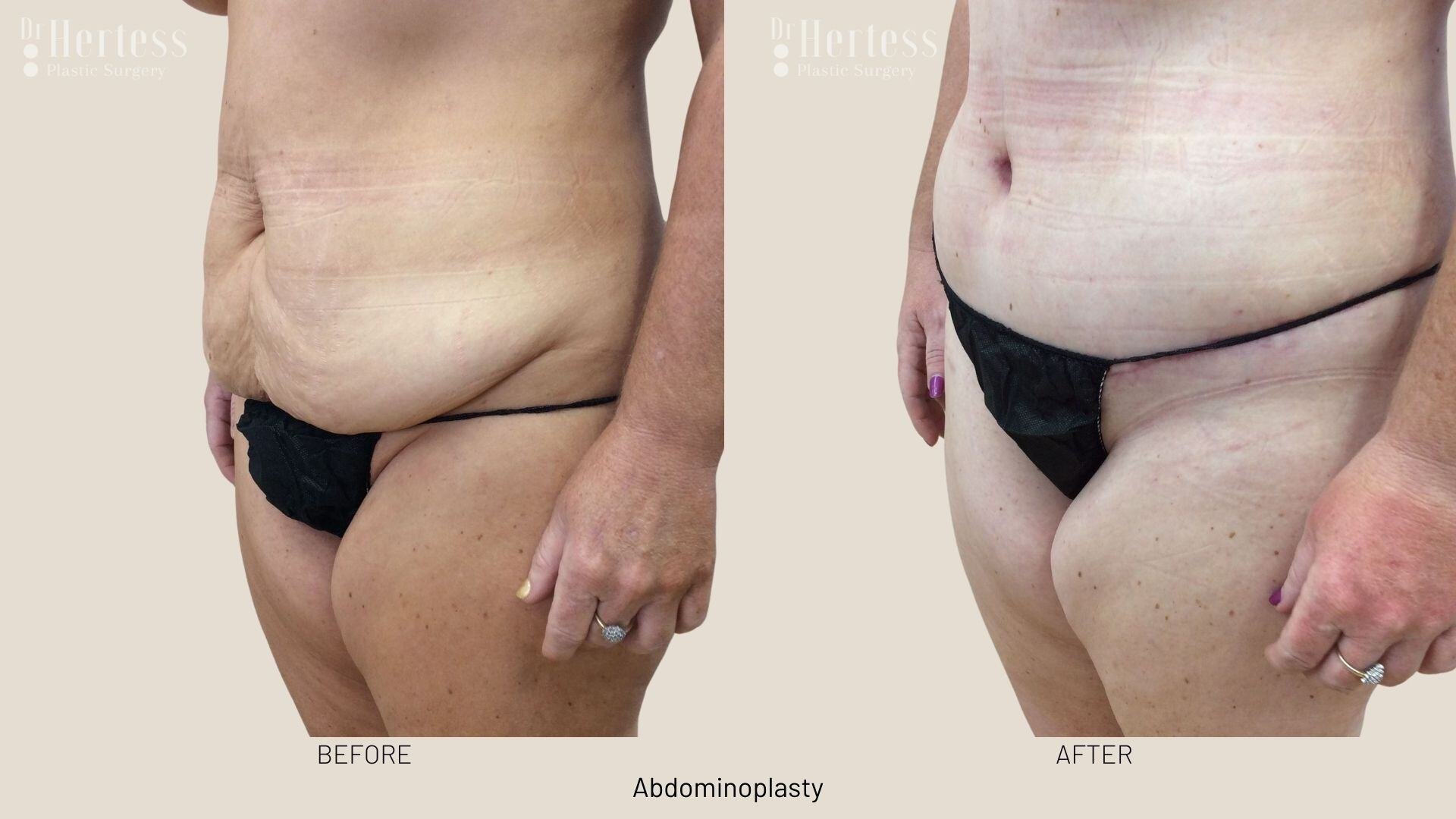 abdominoplasty before and after photos
