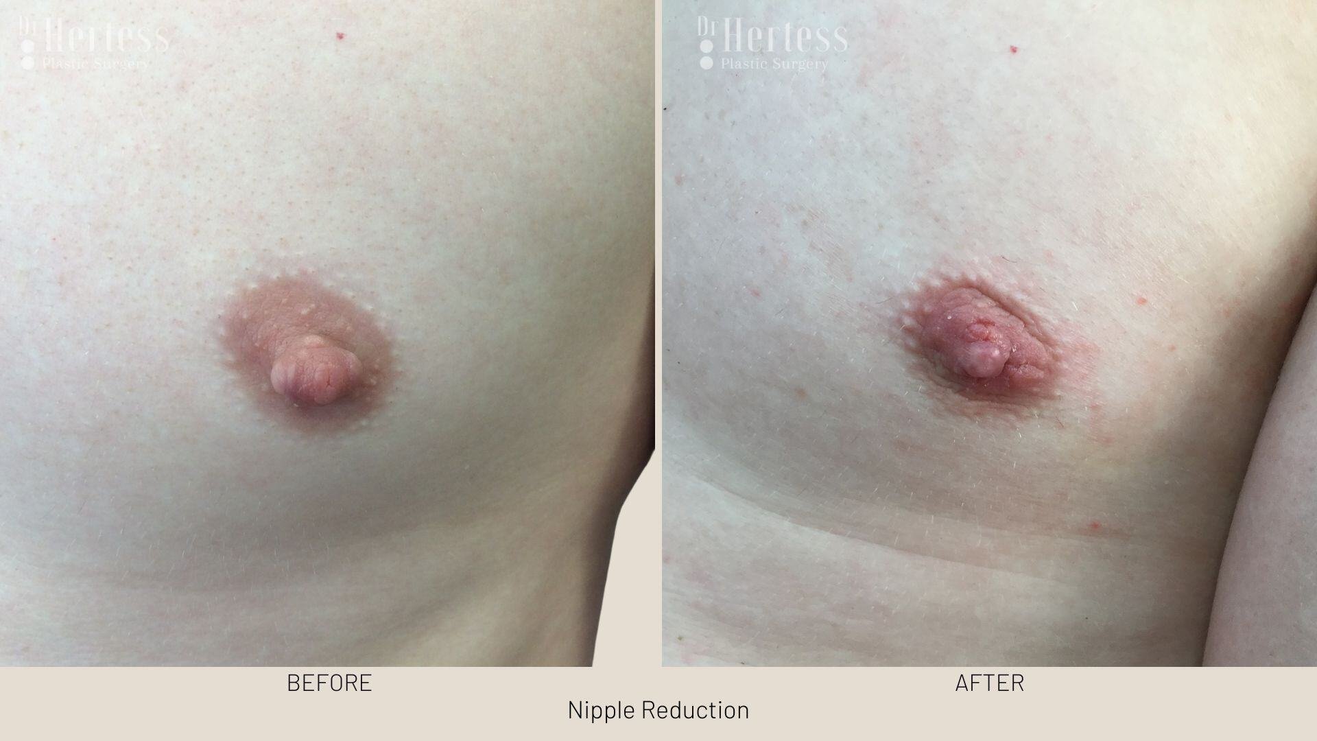 areolar reduction