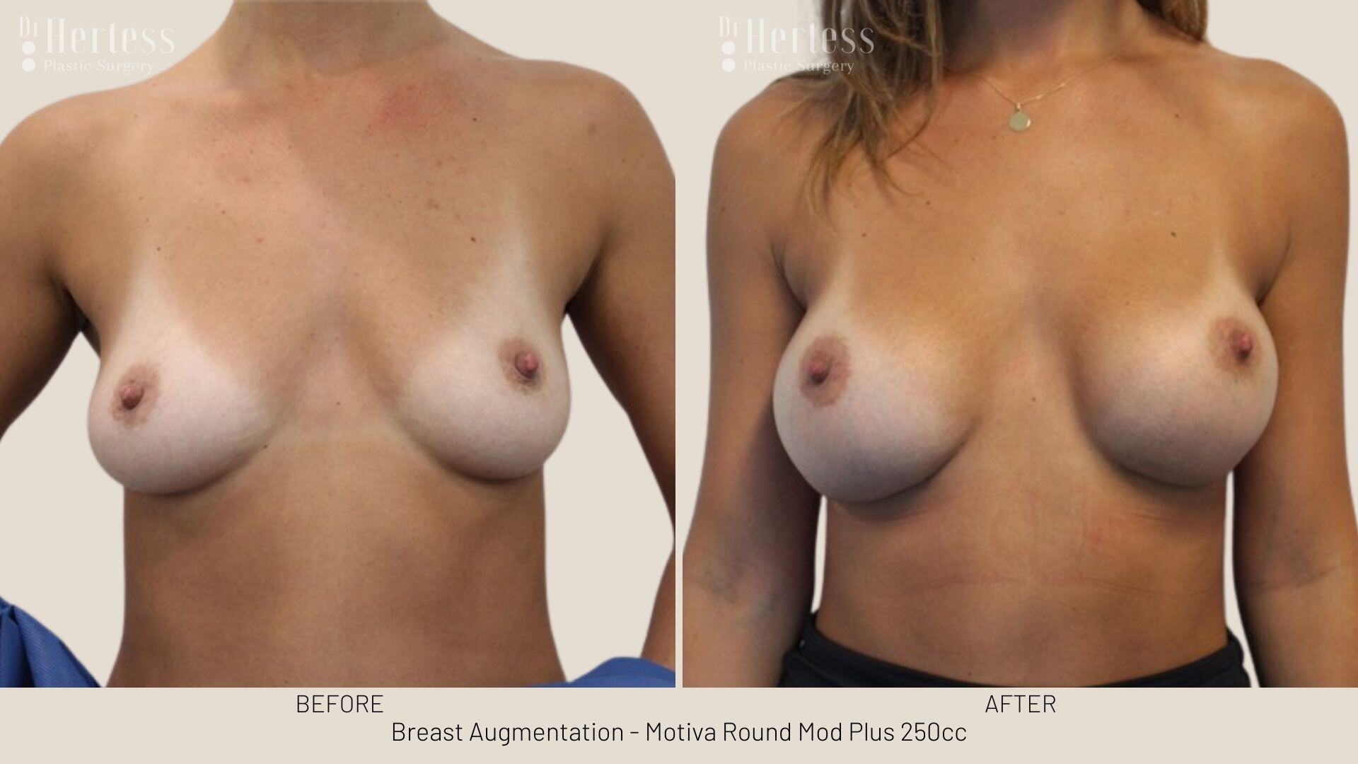 breast augmentation photos before and after