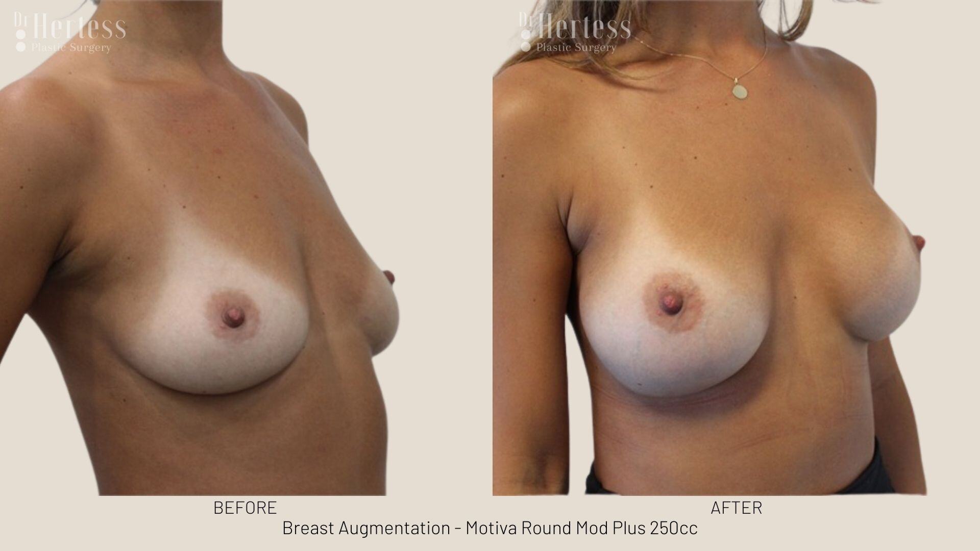 breast augmentation photos before and after