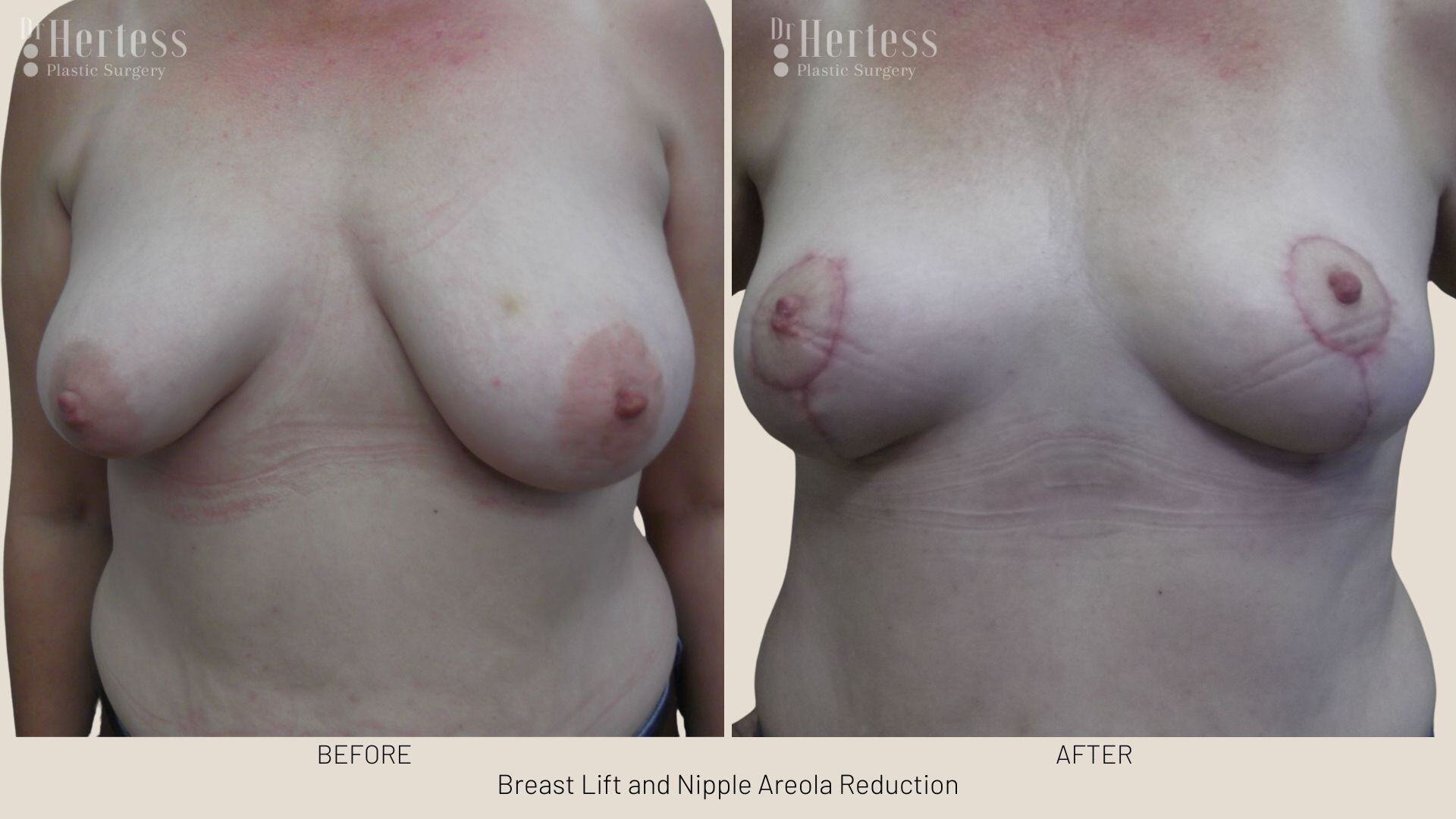 areolar reduction