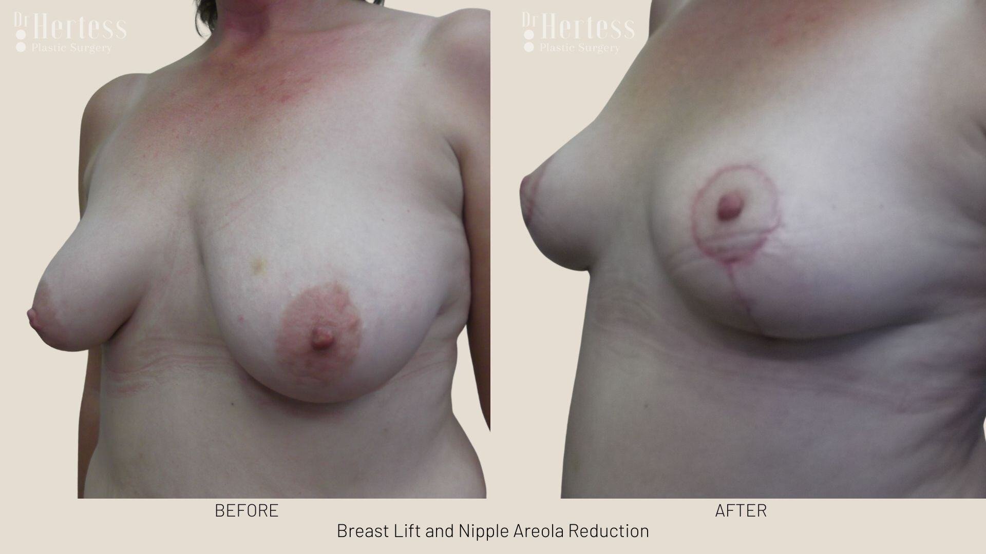 areolar reduction