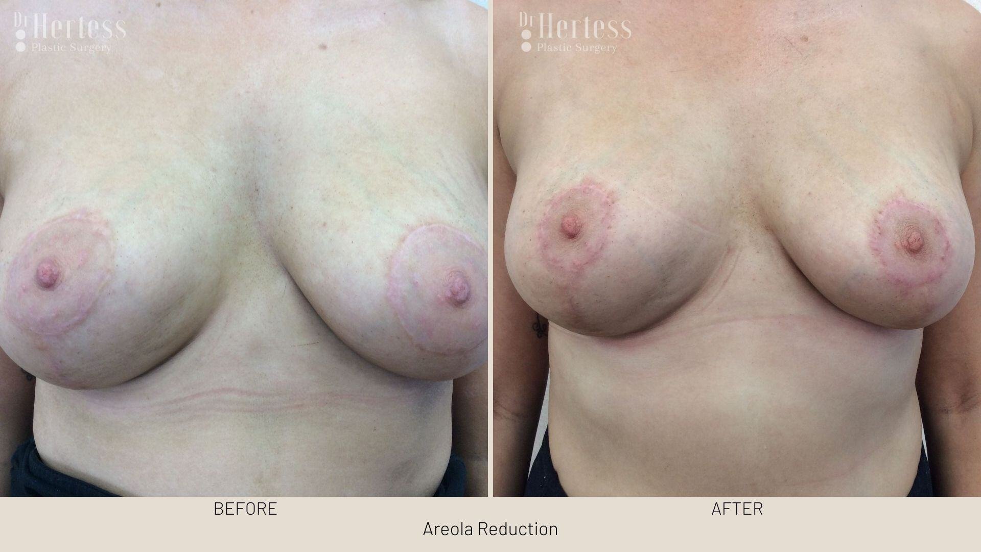 areolar reduction