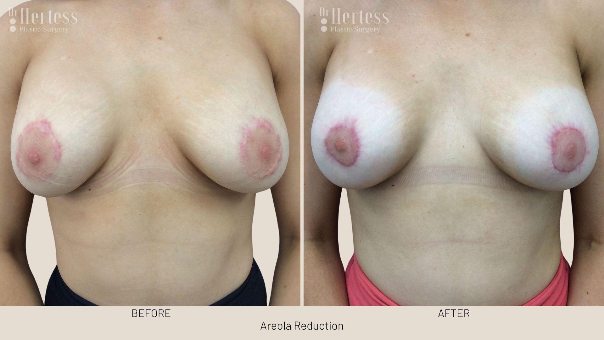 areolar reduction