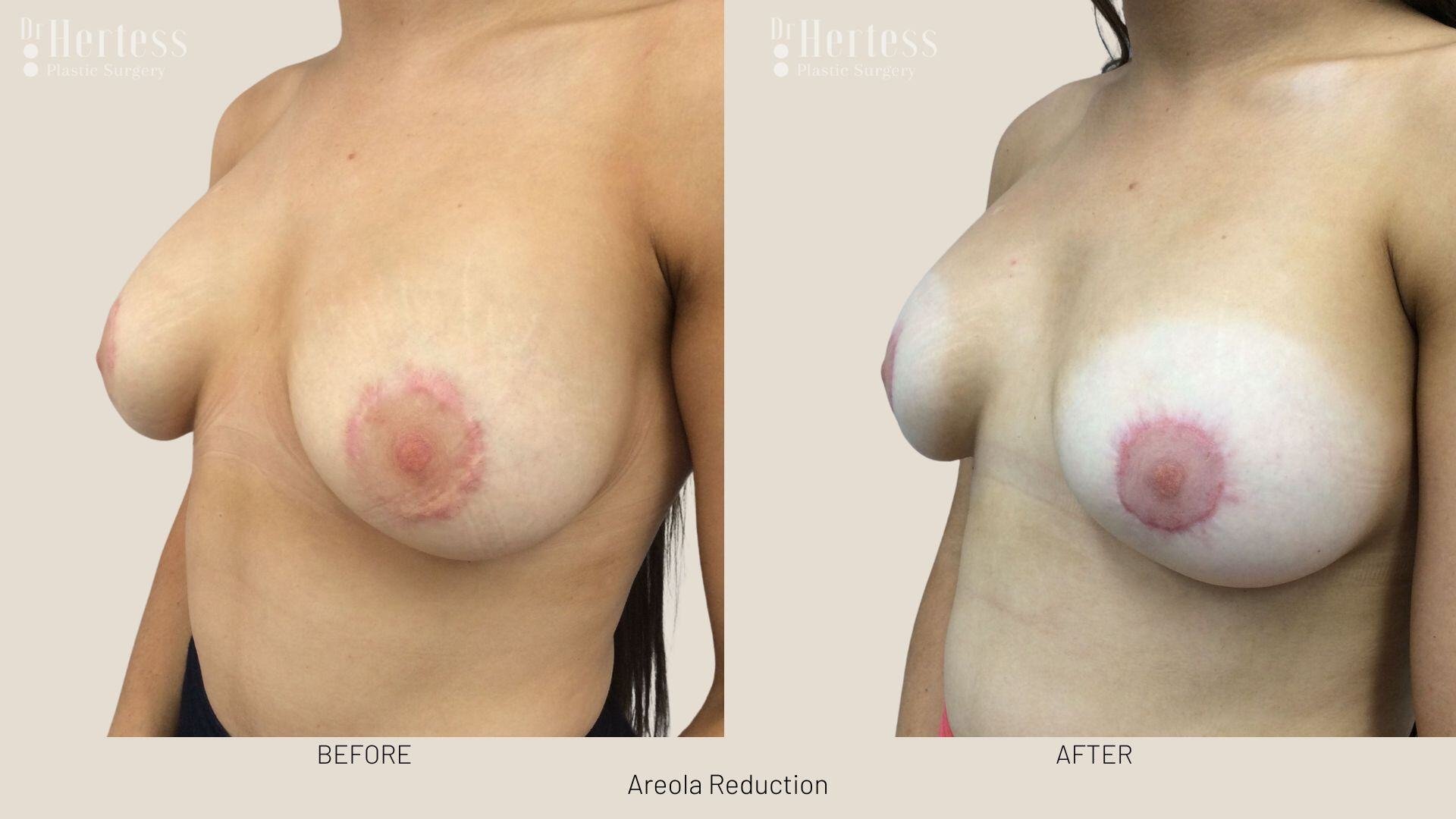areolar reduction