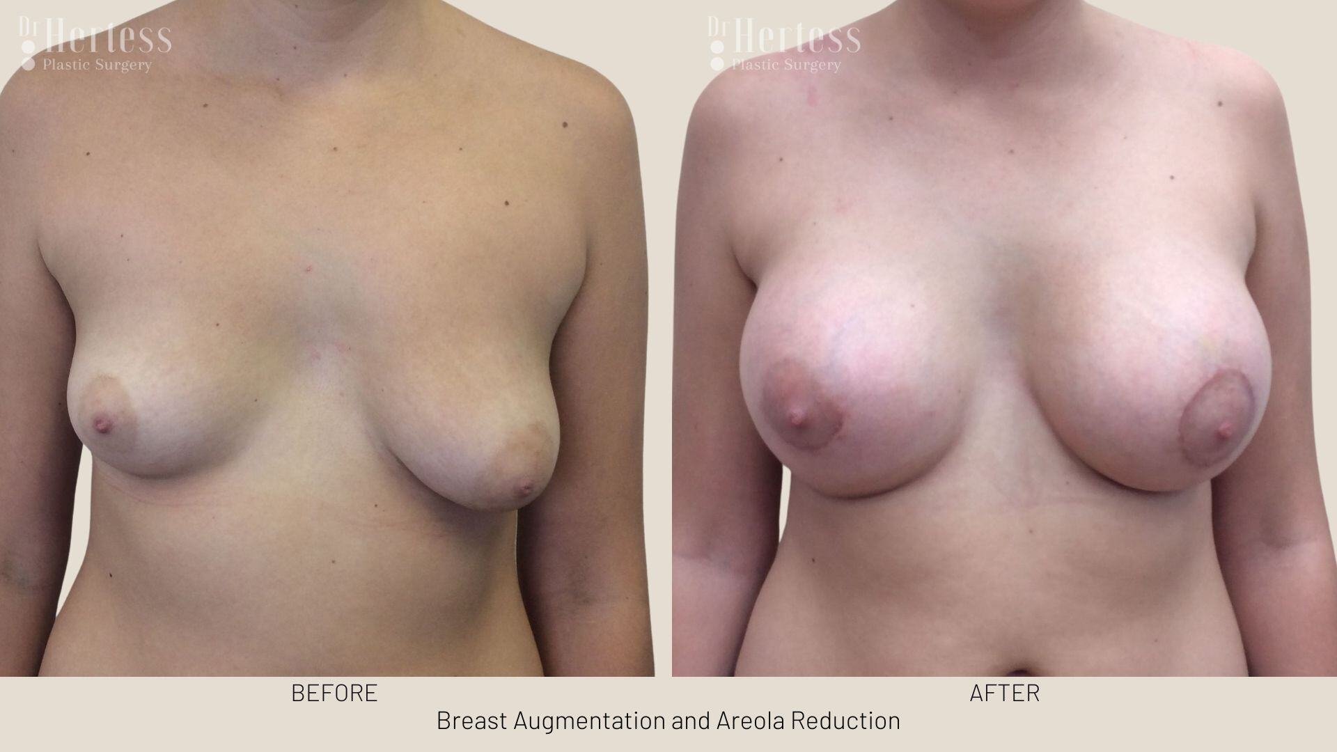 areolar reduction