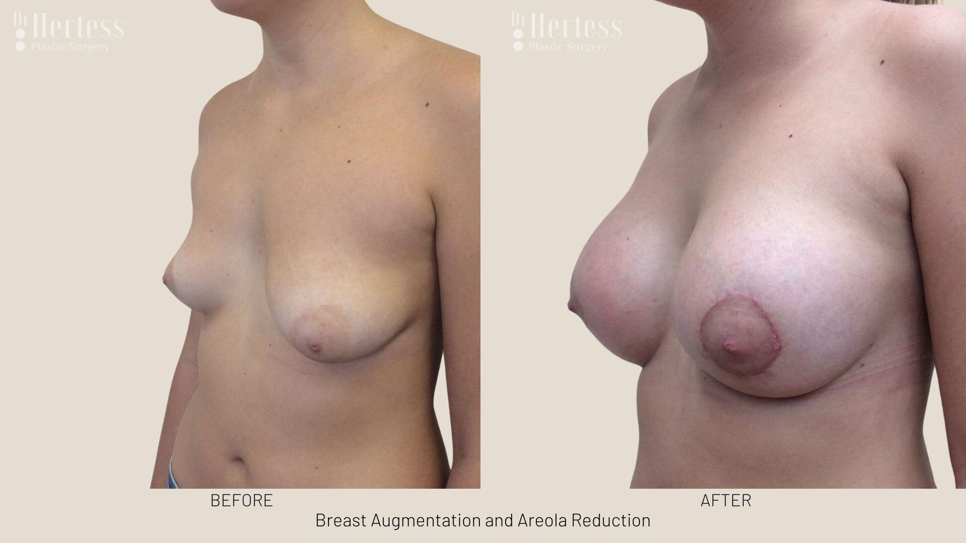 areolar reduction