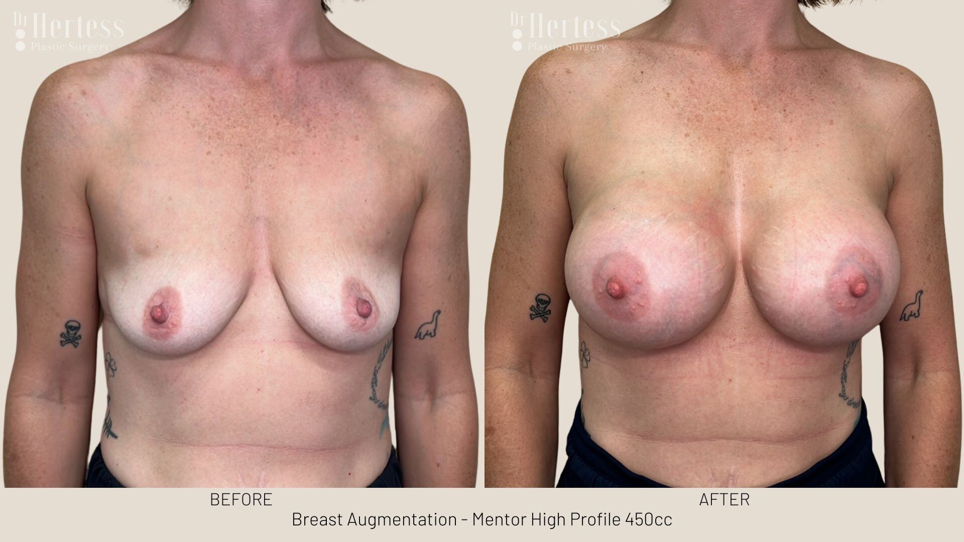 breast augmentation photos before and after
