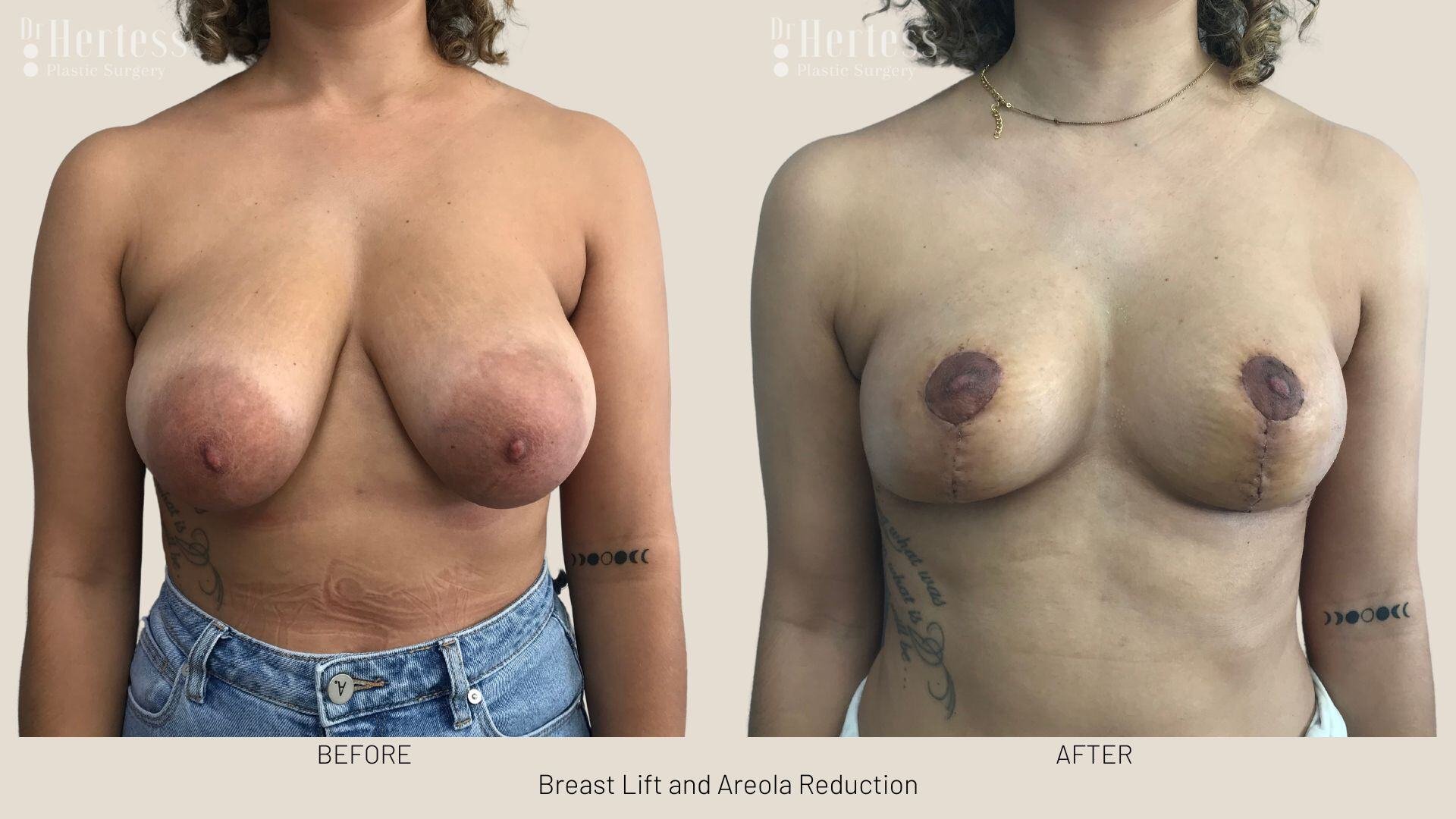 areolar reduction