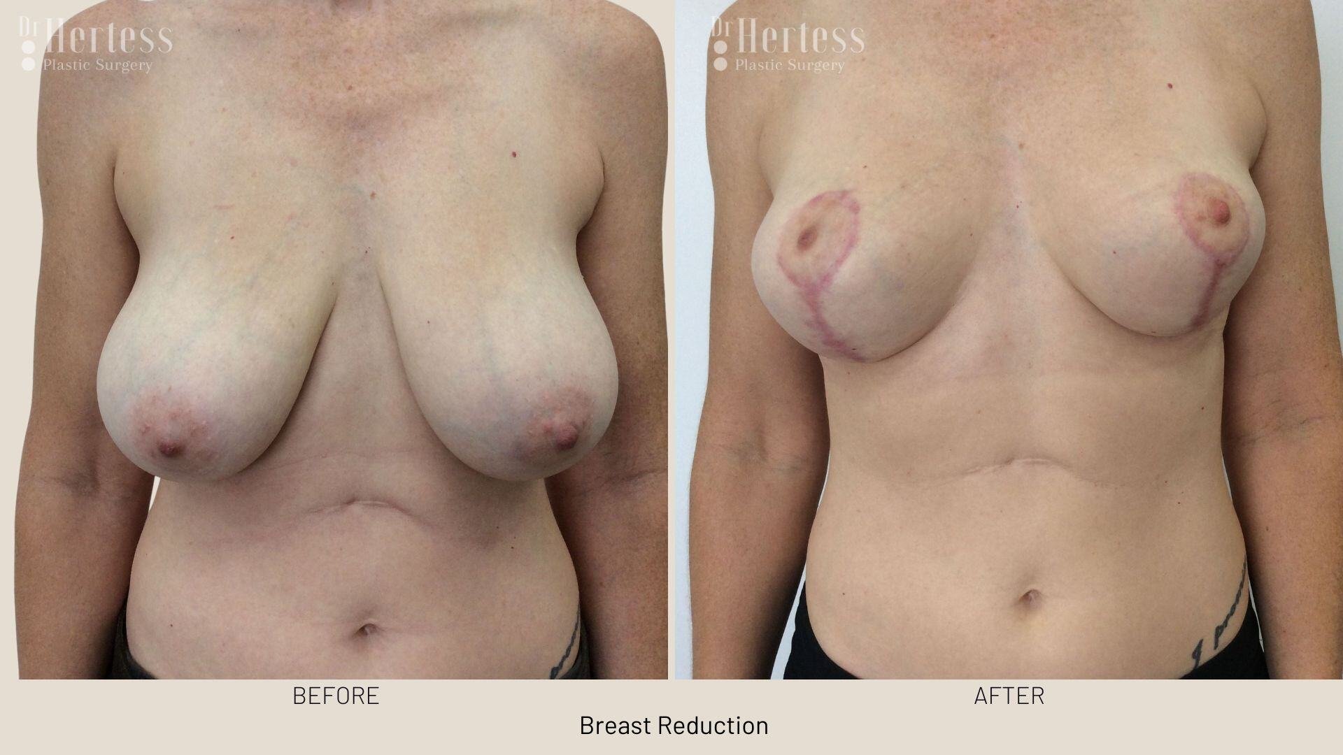 breast reduction before and after