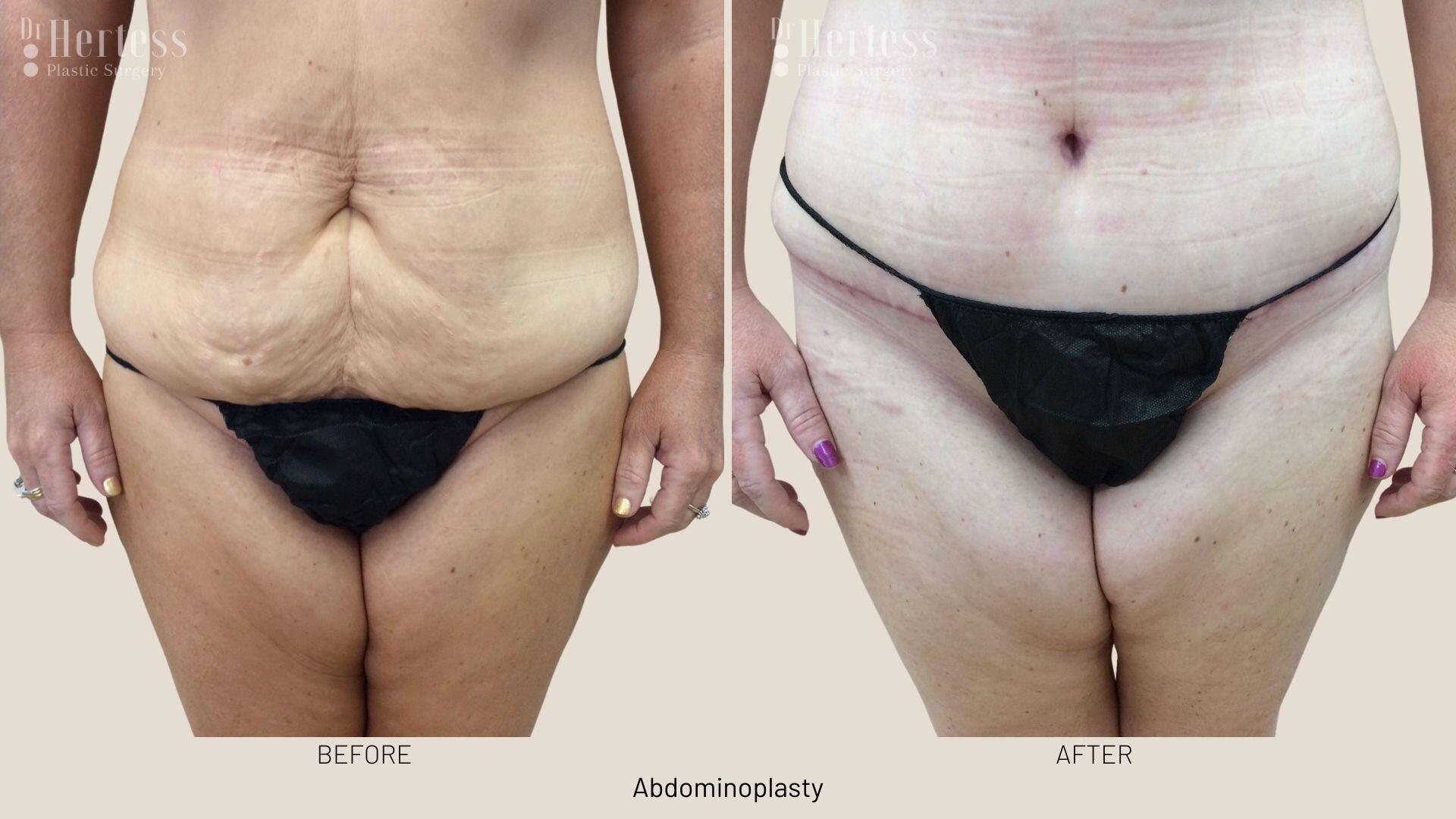 abdominoplasty before and after photos
