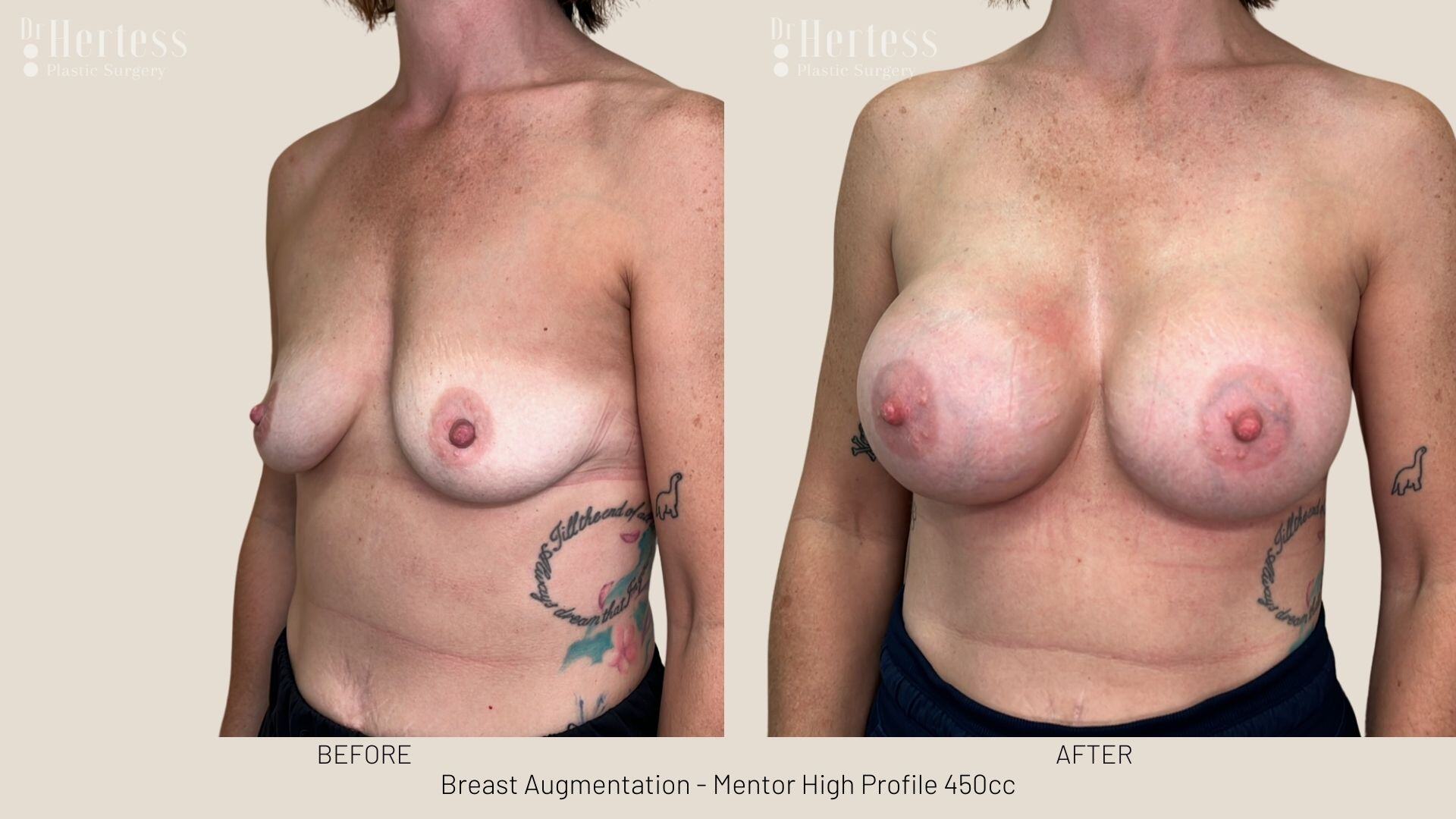 breast augmentation photos before and after