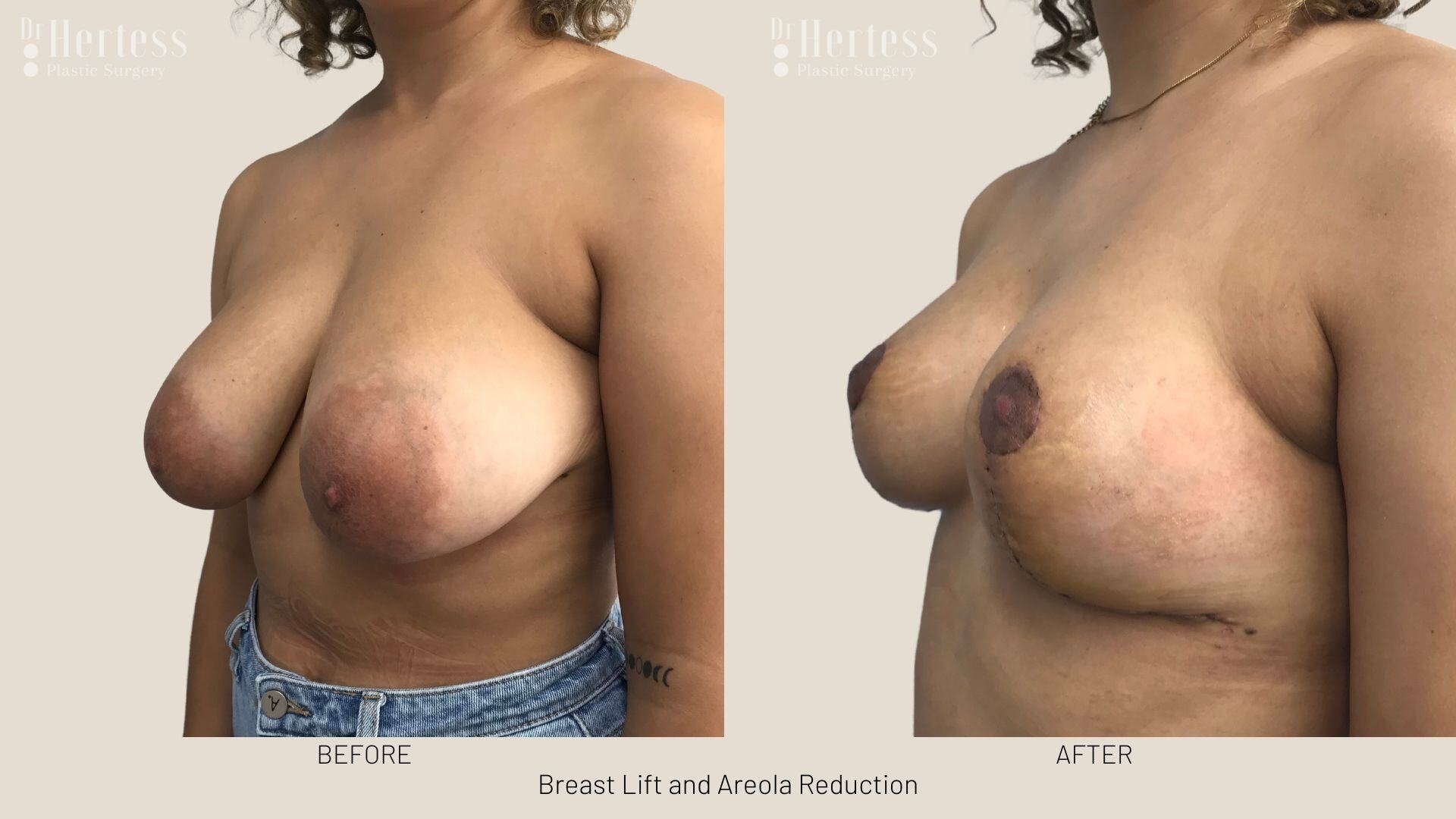 areolar reduction