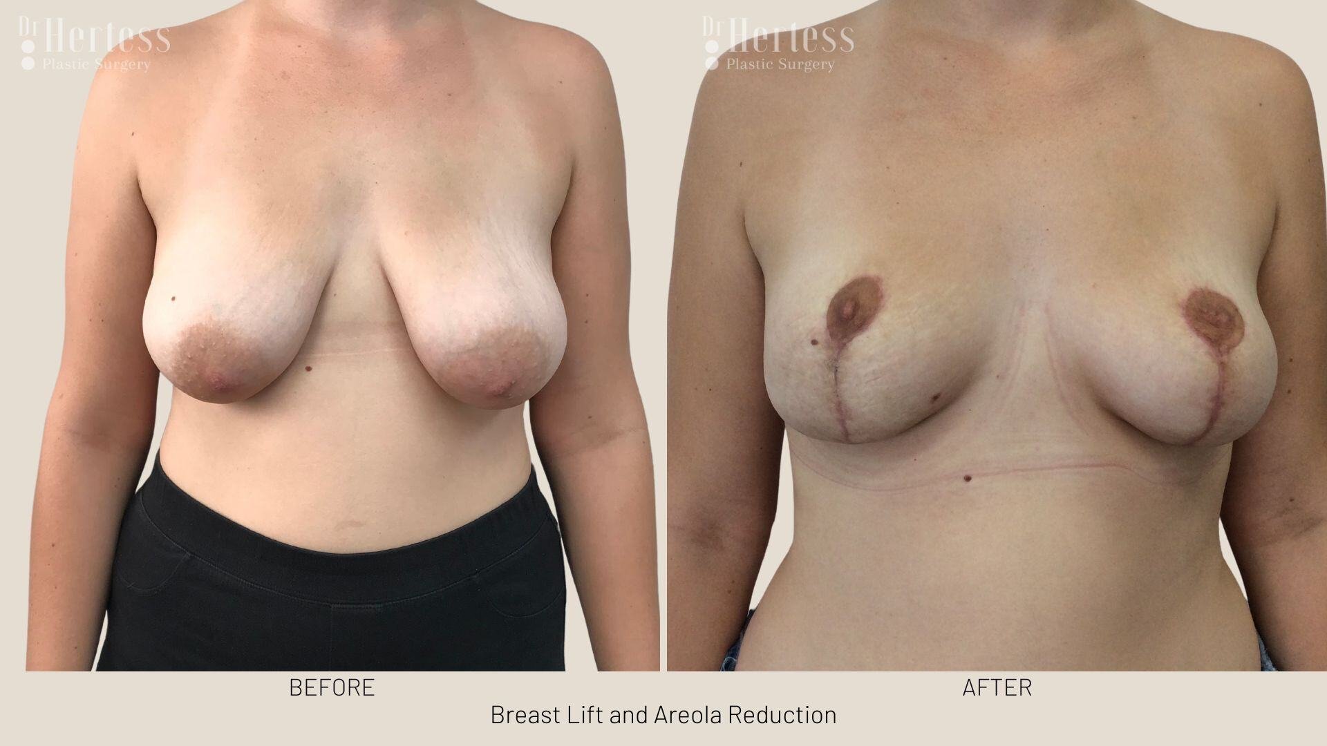 areolar reduction