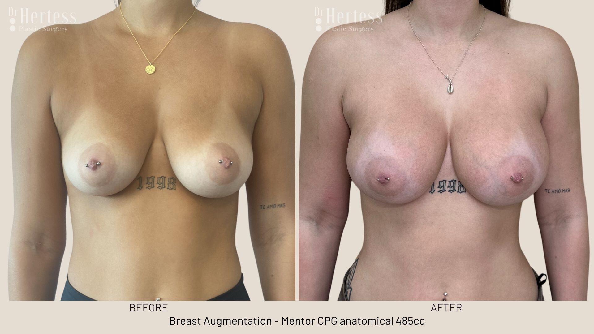 breast augmentation photos before and after
