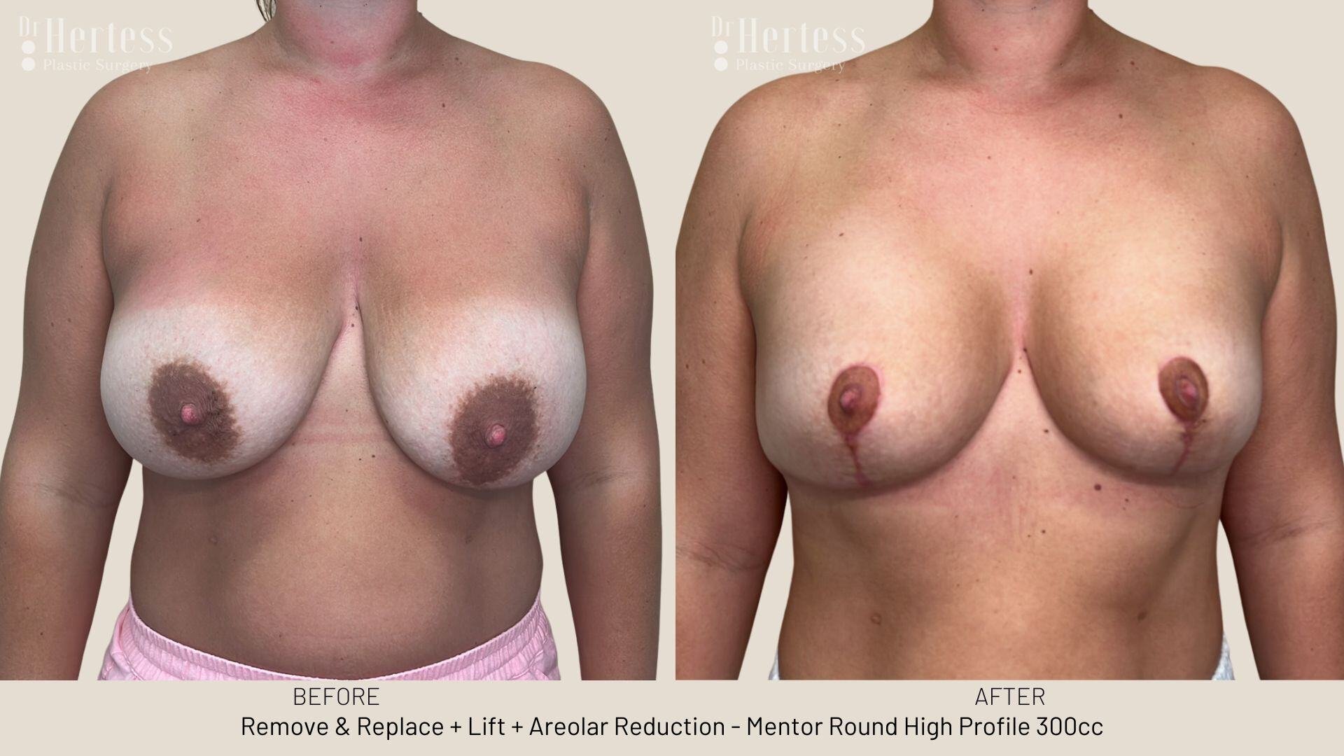 areolar reduction