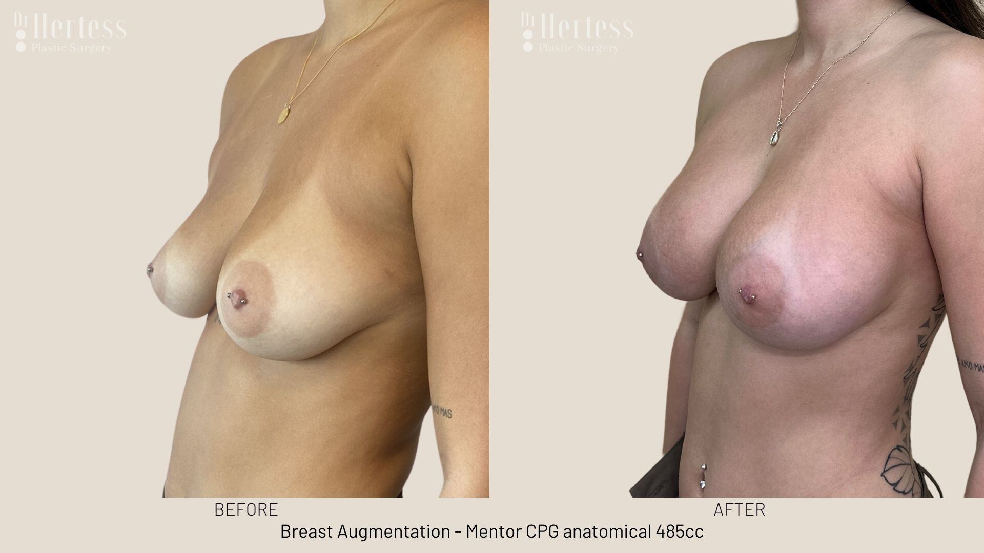breast augmentation photos before and after