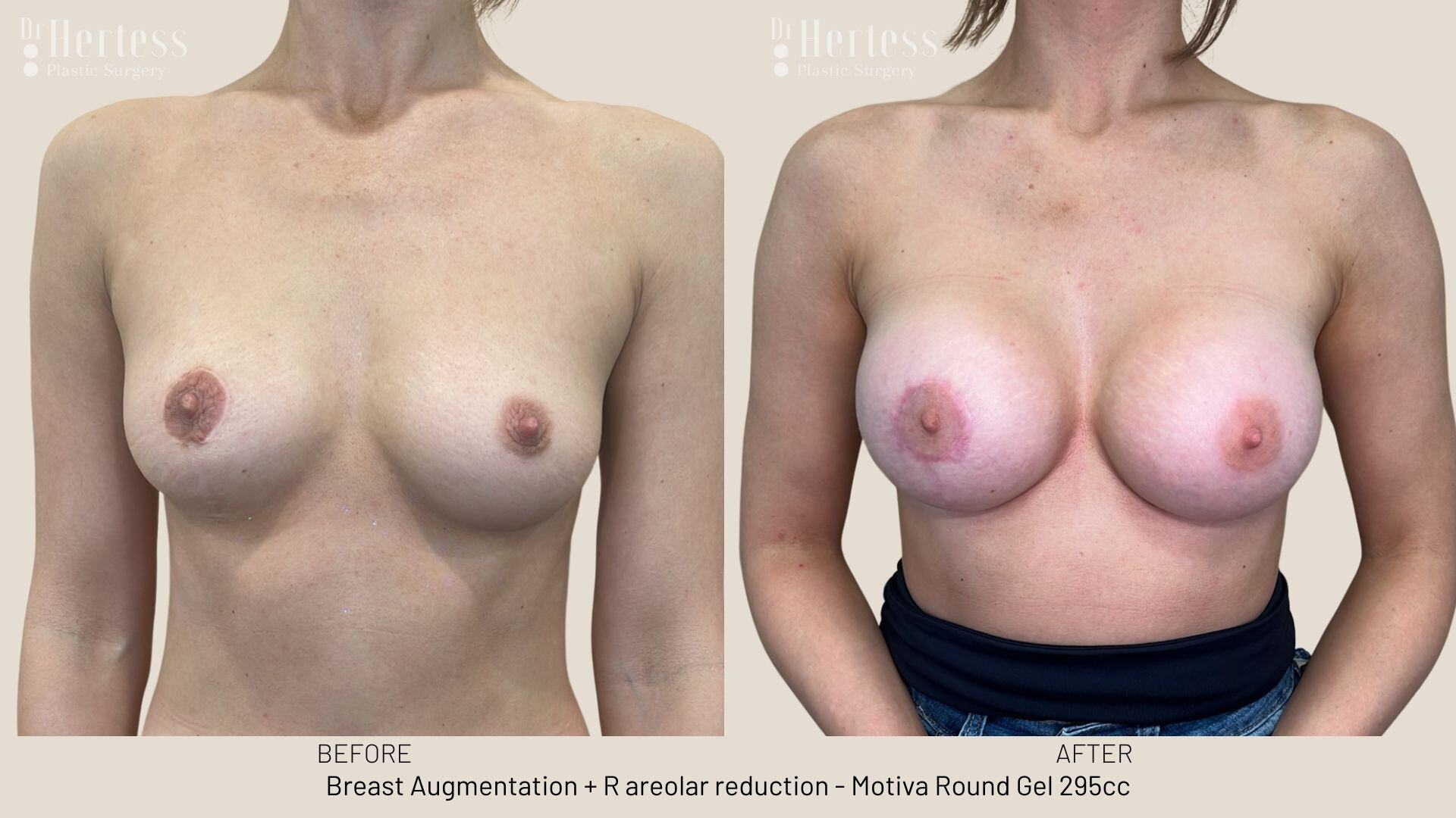 breast augmentation photos before and after