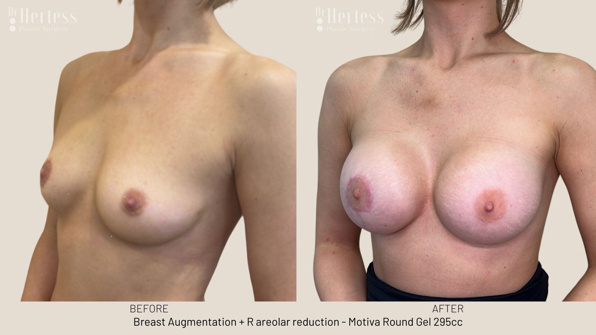 breast augmentation photos before and after