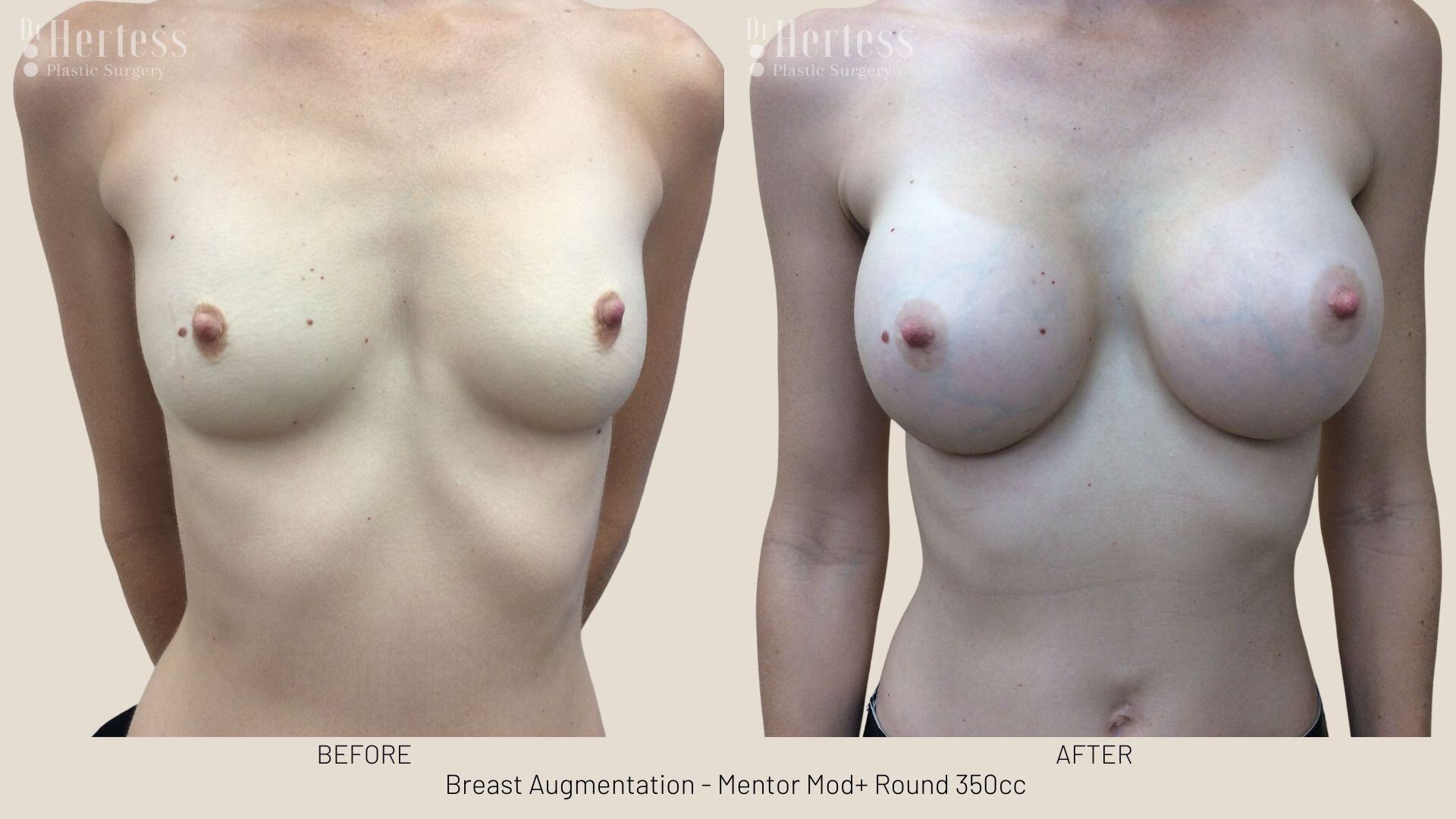 breast implants before and after