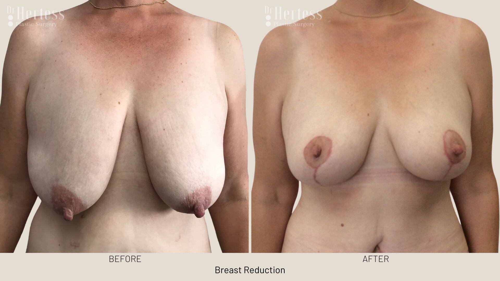 breast reduction before and after