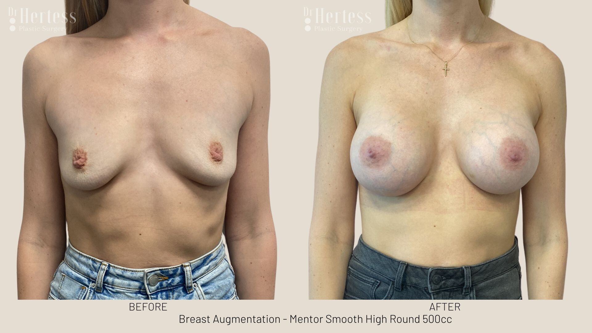 breast implants before and after
