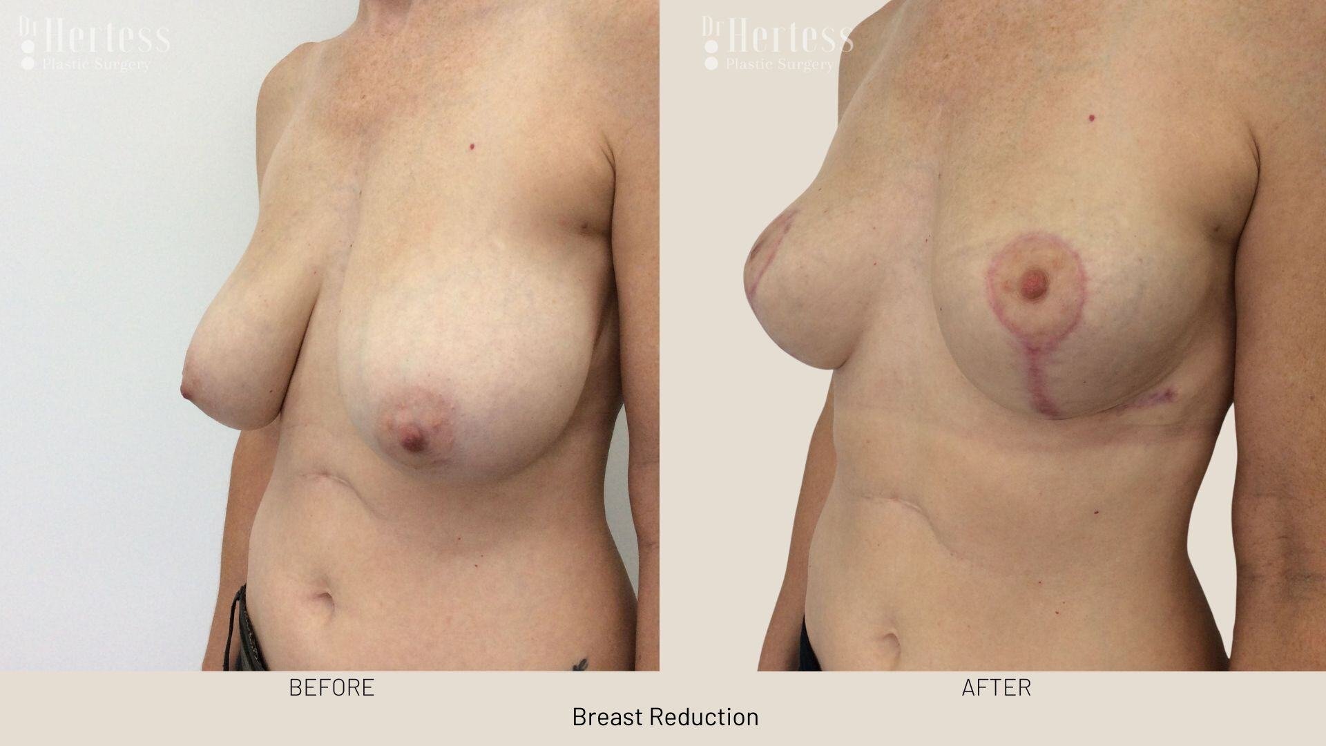 breast reduction before and after