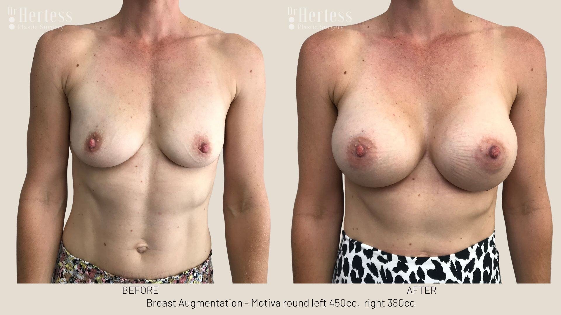 breast aug photos before and after