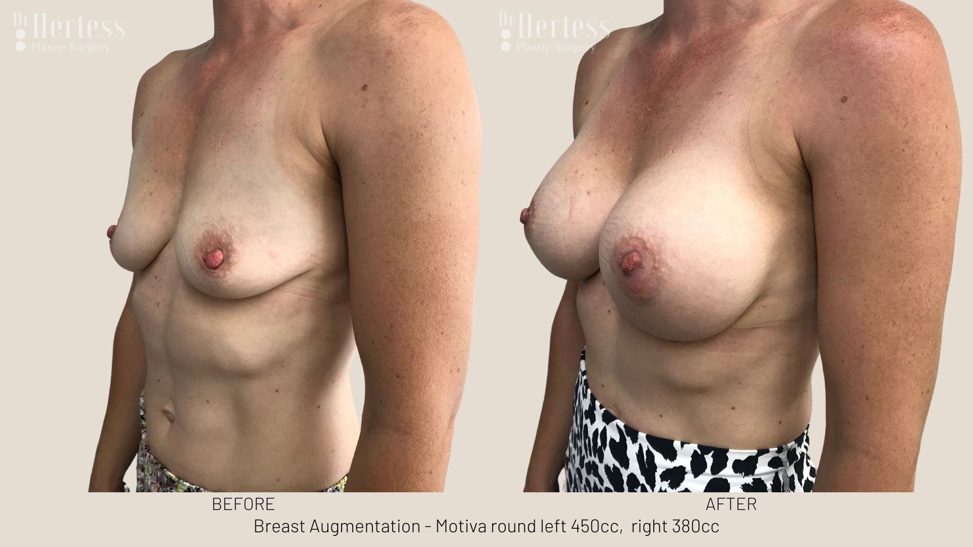breast aug photos before and after