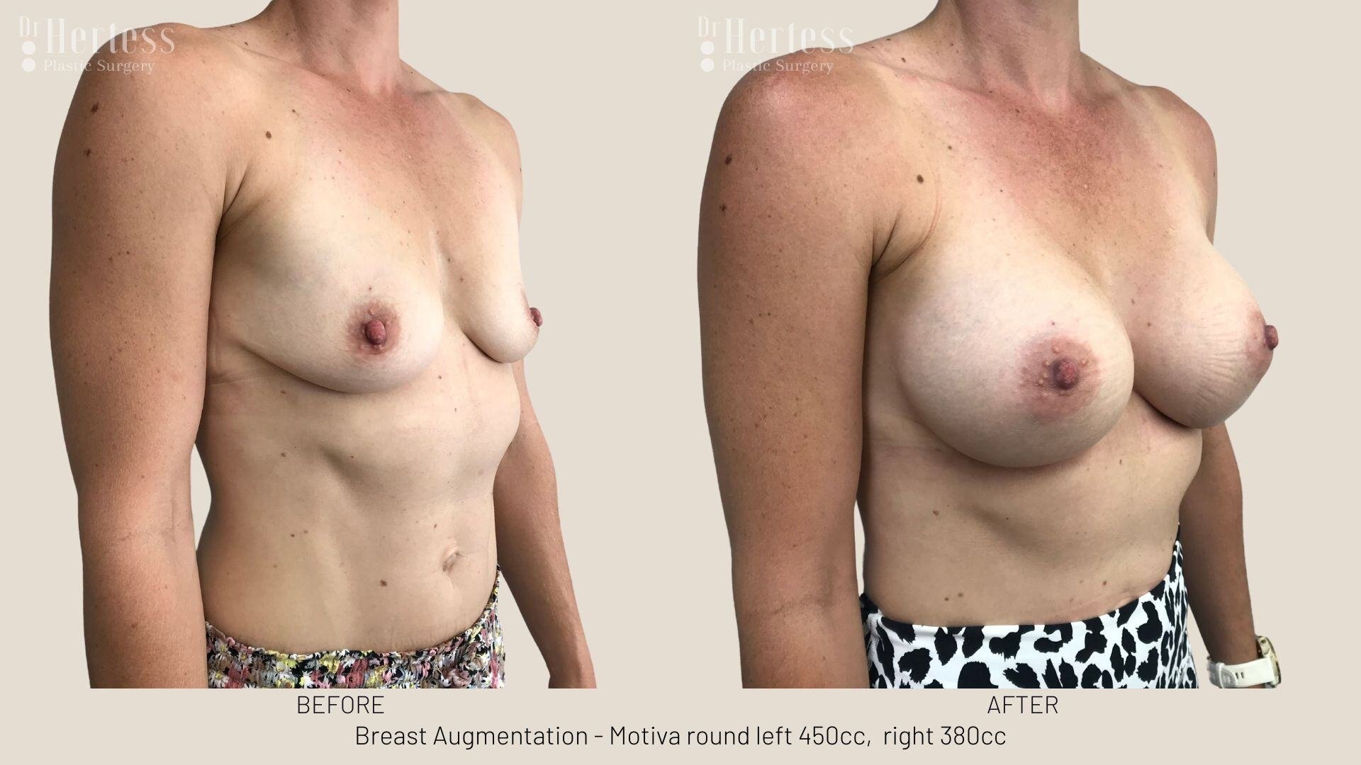 breast aug photos before and after