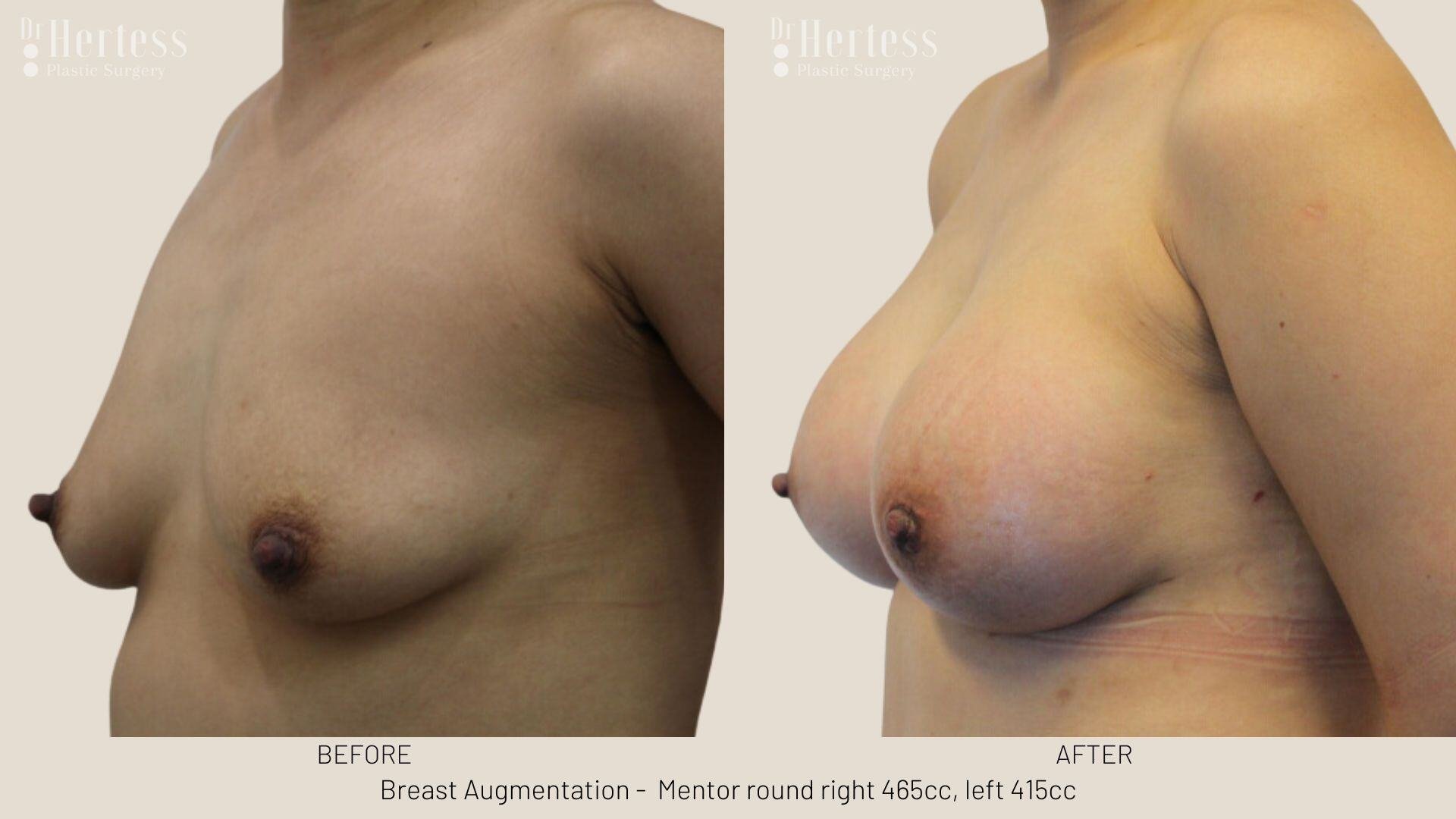 breast aug photos before and after