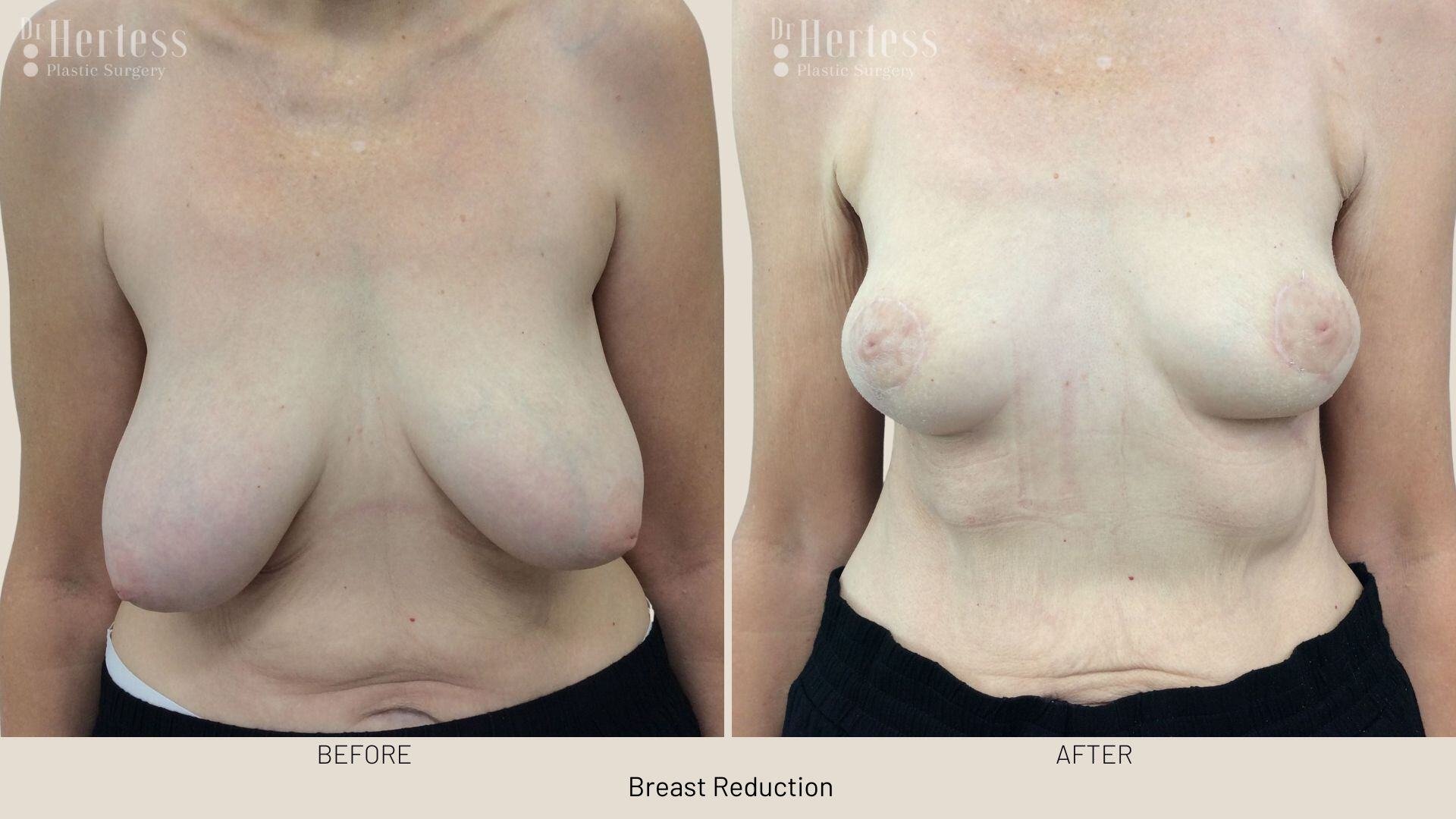 breast reduction before and after