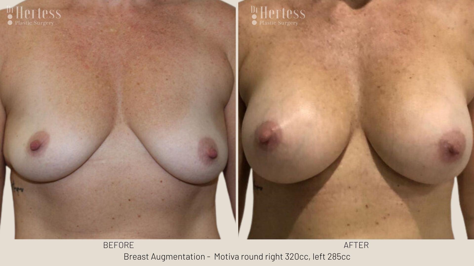 breast aug photos before and after