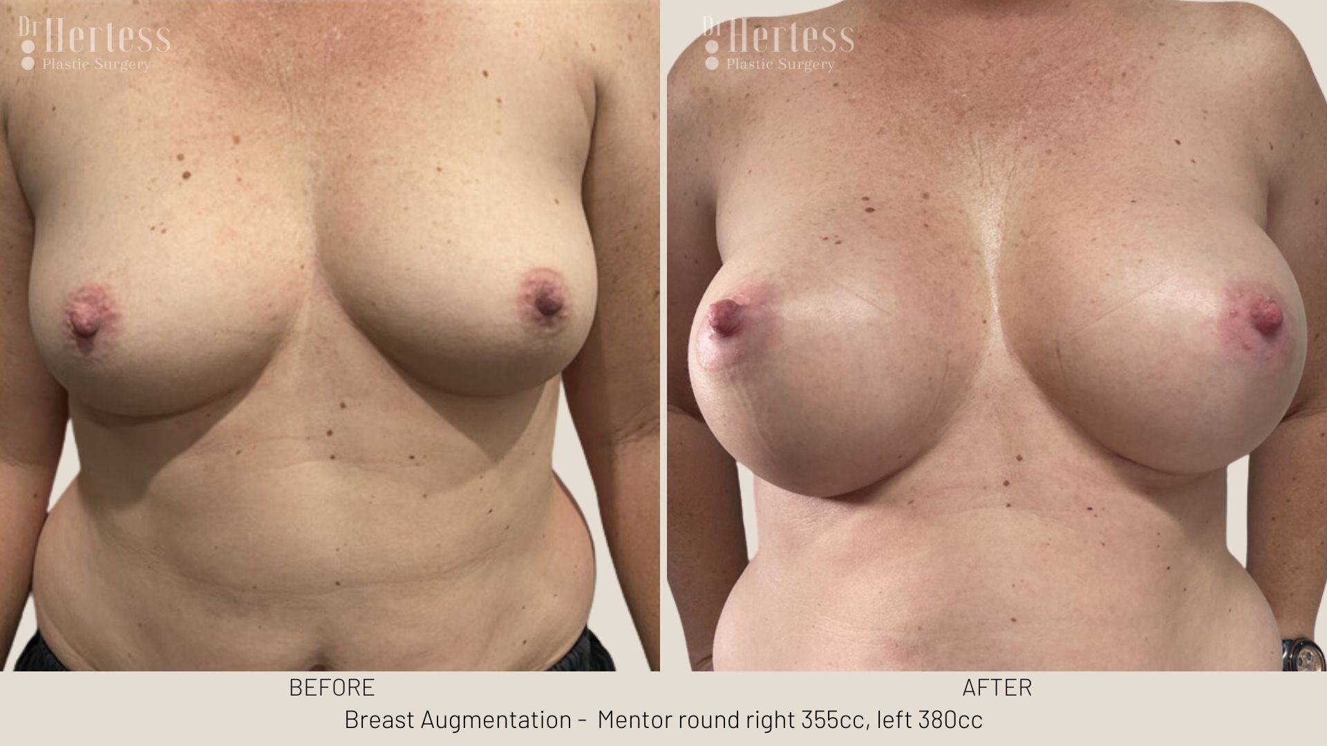 breast aug photos before and after