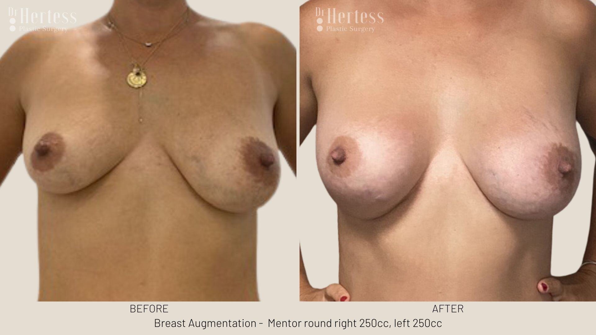 breast aug photos before and after