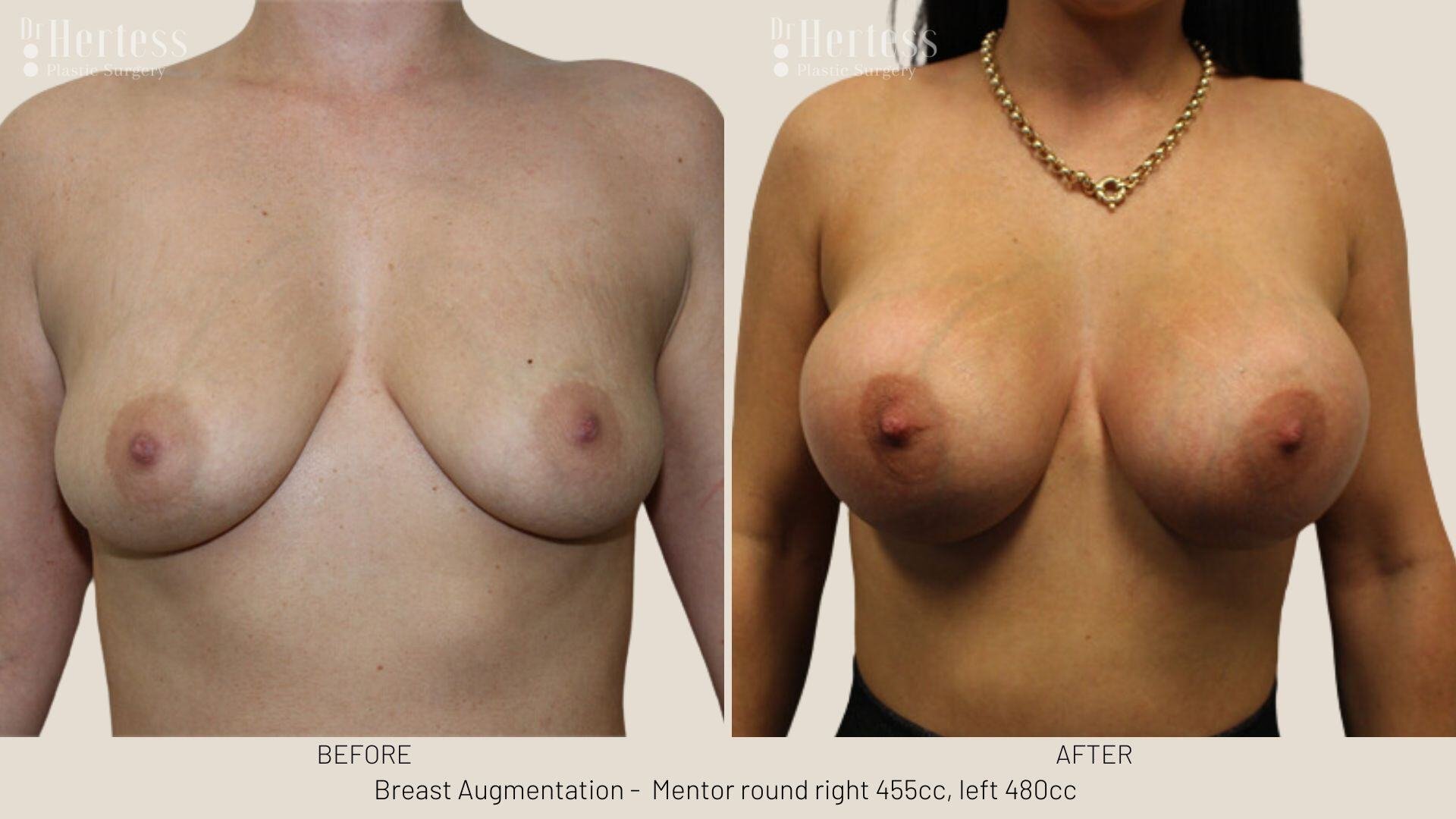 breast aug photos before and after