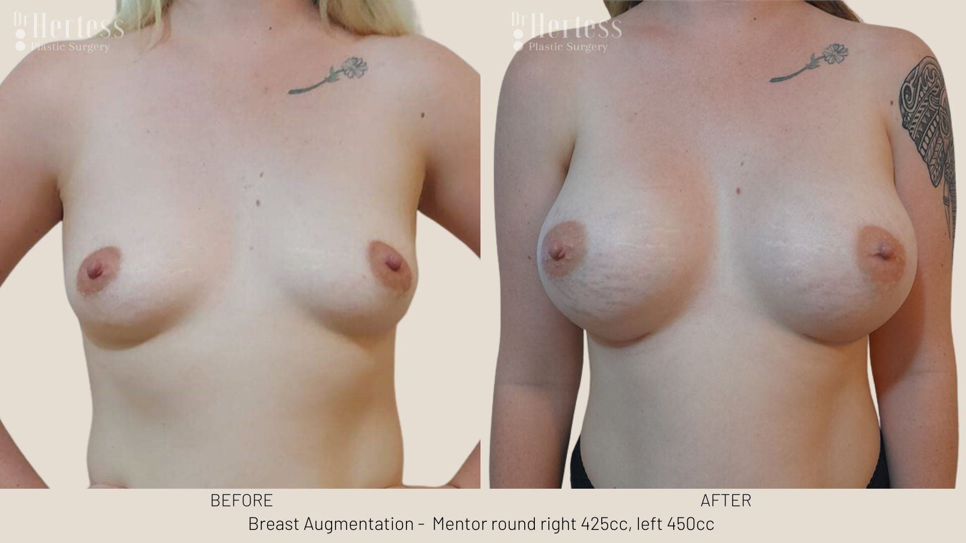 breast aug photos before and after