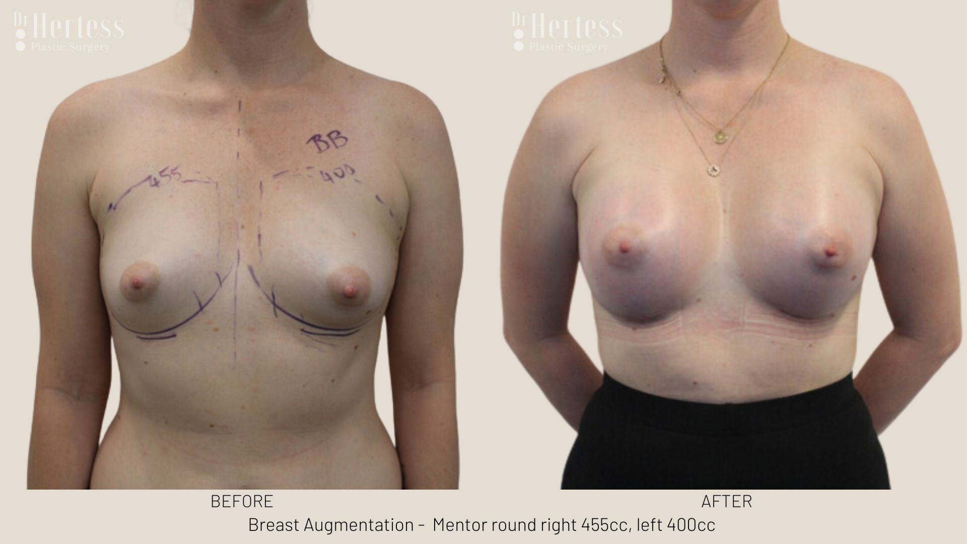 breast aug photos before and after