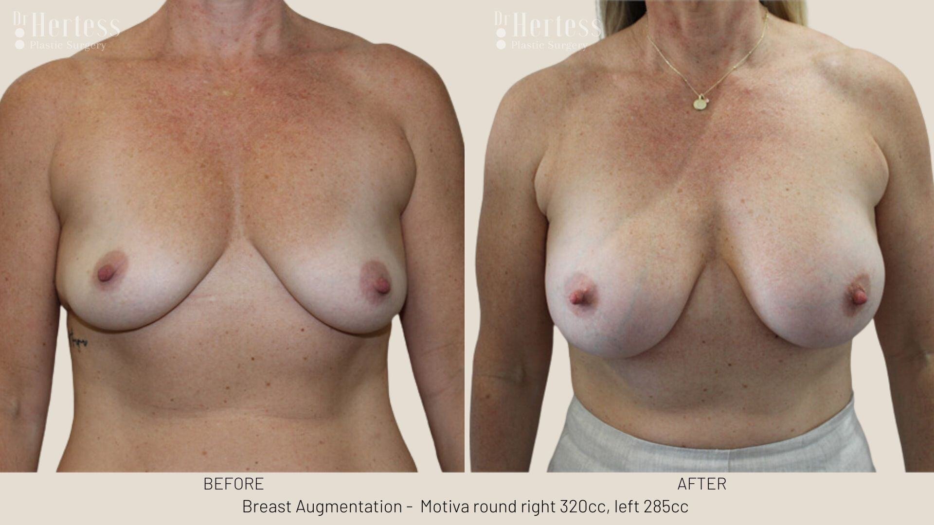breast aug photos before and after