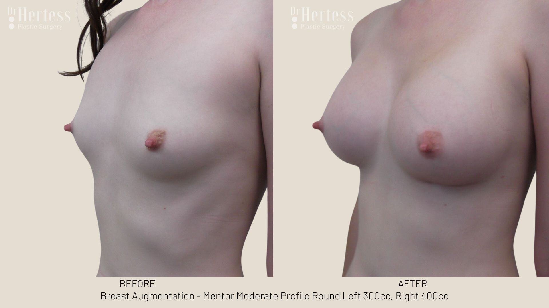 breast aug photos before and after