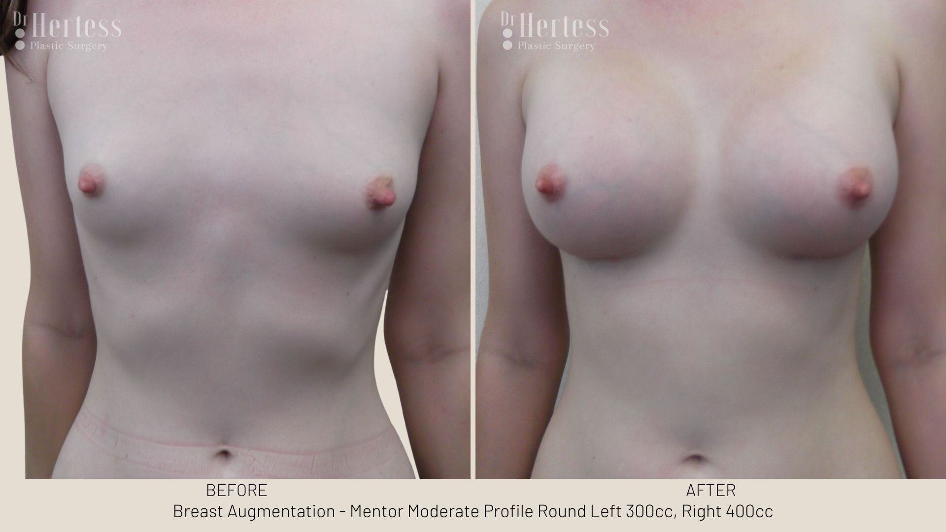 breast aug photos before and after
