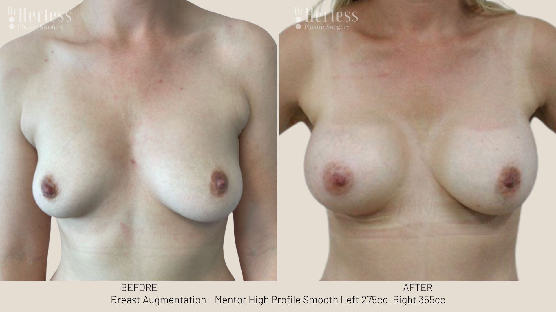 breast aug photos before and after