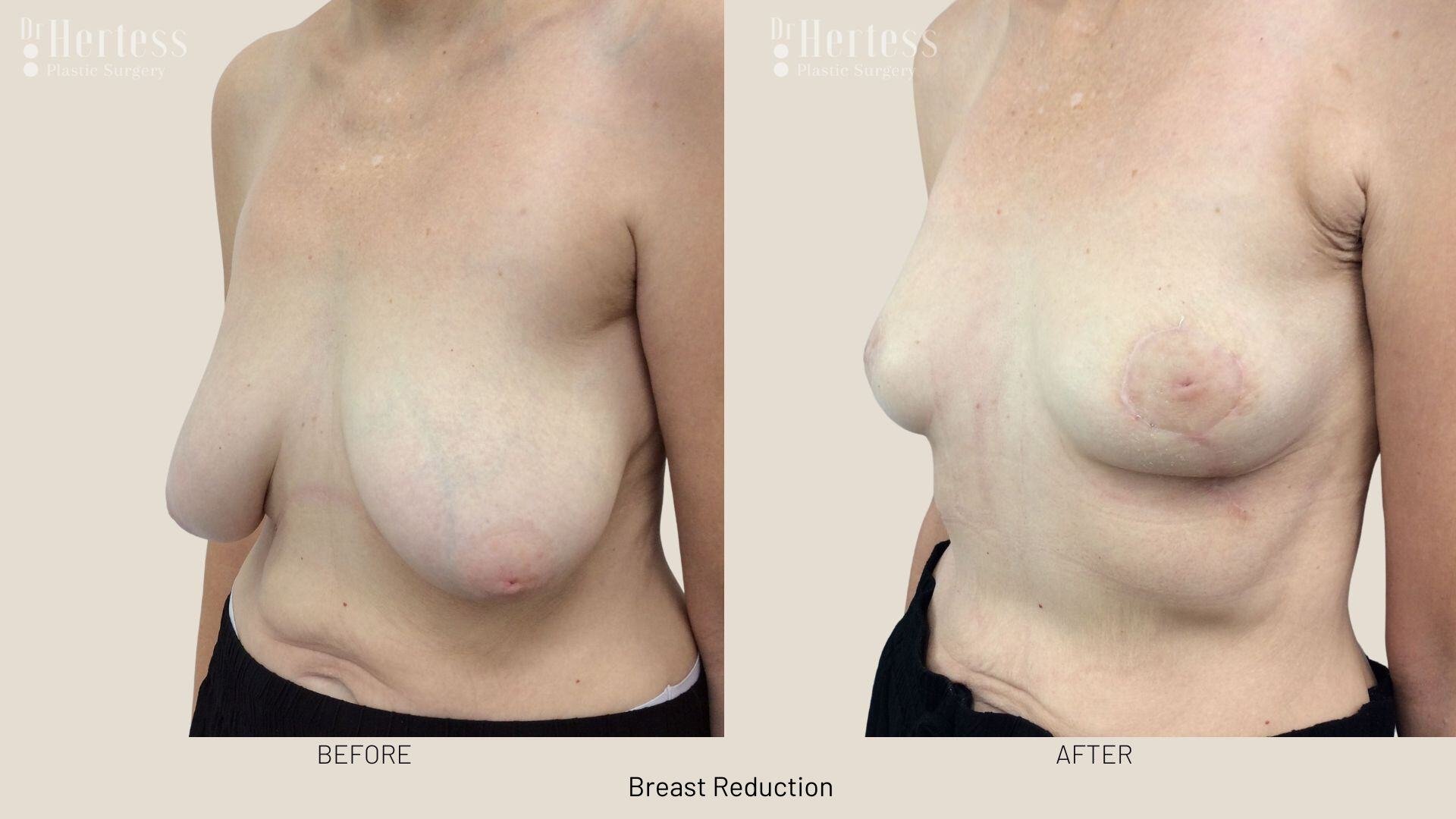 22-4breast reduction before and after