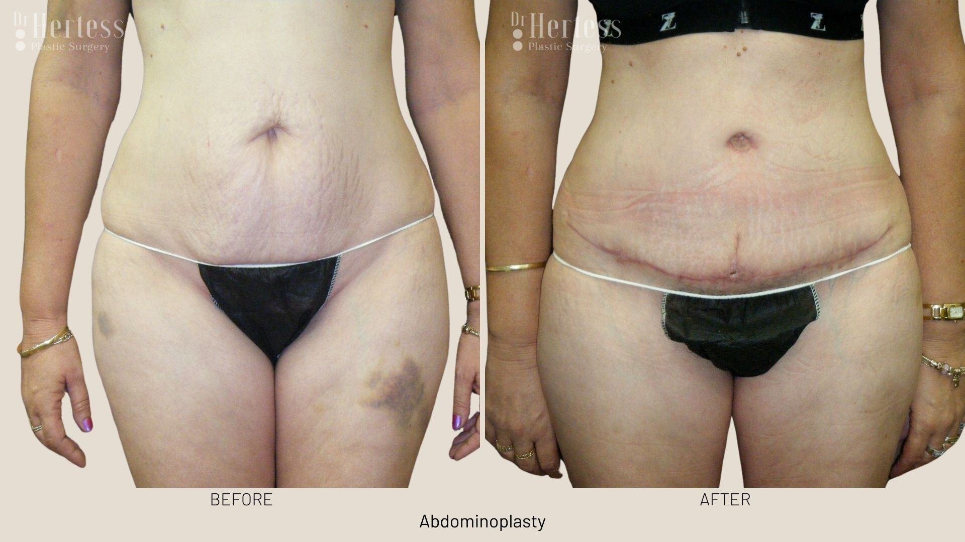 abdominoplasty before and after photos
