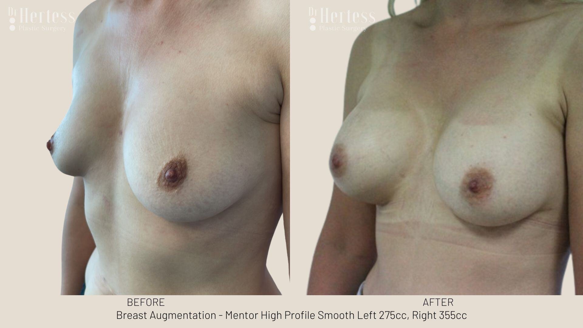 breast aug photos before and after